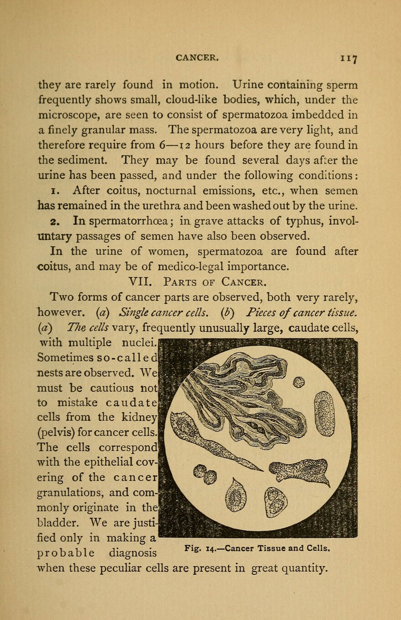 they are rarely found in motion. Urine containing sperm frequently shows small, cloud-like bodies, which, under the microscope, are seen to consist of spermatozoa imbedded in a finely granular mass. The spermatozoa are very light, and therefore require from 6—12 hours before they are found in the sediment. They may be found several days af::er the urine has been passed, and under the following conditions : 1. After coitus, nocturnal emissions, etc., when semen has remained in the urethra and been washed out by the urine. 2. In spermatorrhoea; in grave attacks of typhus, invol- untary passages of semen have also been observed. In the urine of women, spermatozoa are found after coitus, and may be of medico-legal importance. VII. Parts of Cancer. Two forms of cancer parts are observed, both very rarely, however, {a) Single cancer cells, {b) Pieces of cancer tissue. {a) TJie cells vary, frequently unusually large, caudate cells, with multiple nuclei, j Sometimes s o - c a 11 e 1 nests are observed. We| must be cautious not to mistake caudate! cells from the kidney! (pelvis) for cancer cells.l The cells correspond] with the epithelial cov- ering of the cancer] granulations, and com-! monly originate in thej bladder. We are justi- fied only in making a' probable diagnosis ^'^' I4.-Cancer Tissue and Cells. when these peculiar cells are present in great quantity.