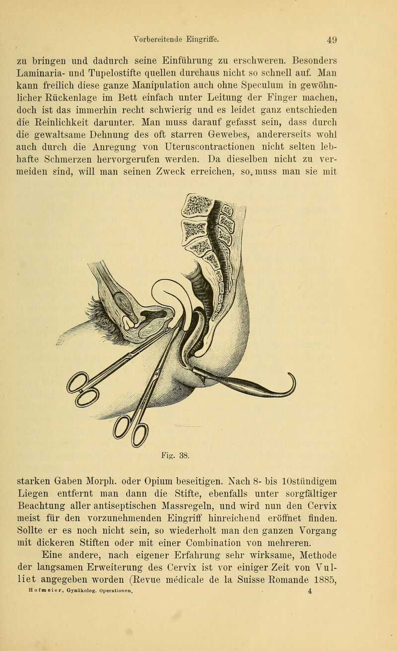 zu bringen und dadurch seine Einführung zu erschweren. Besonders Laminaria- und Tupelostifte quellen durchaus nicht so schnell auf. Man kann freilich diese ganze Manipulation auch ohne Speculum in gewöhn- licher Eückenlage im Bett einfach unter Leitung der Finger machen, doch ist das immerhin recht schwierig und es leidet ganz entschieden die Reinlichkeit darunter. Man muss darauf gefasst sein, dass durch die gewaltsame Dehnung des oft starren Gewebes, andererseits wohl auch durch die Anregung von Uteruscontractionen nicht selten leb- hafte Schmerzen hervorgerufen werden. Da dieselben nicht zu ver- meiden sind, will man seinen Zweck erreichen, so. muss man sie mit Fis-. 38. starken Gaben Morph, oder Opium beseitigen. Nach 8- bis lOstündigem Liegen entfernt man dann die Stifte, ebenfalls unter sorgMtiger Beachtung aller antiseptischen Massregeln, und wird nun den Cervix meist für den vorzunehmenden Eingriff hinreichend eröffnet finden. Sollte er es noch nicht sein, so wiederholt man den ganzen Vorgang mit dickeren Stiften oder mit einer Combination von mehreren. Eine andere, nach eigener Erfahrung sehr wirksame, Methode der langsamen Erweiterung des Cervix ist vor einiger Zeit von Vul- liet angegeben worden (ßevue medicale de la Suisse Eomande 1885, Hofmeier, Gynäkolog. Operationen. . 4