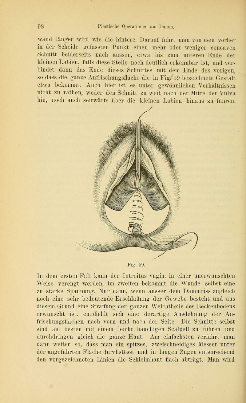 wand länger wird wie die hintere. Darauf führt man von dem vorher in der Scheide gefassten Punkt einen mehr oder weniger concaven Schnitt beiderseits nach aussen, etwa bis zum unteren Ende der kleinen Labien, falls diese Stelle noch deutlich erkennbar ist, und ver- bindet dann das Ende dieses Schnittes mit dem Ende des vorigen, so dass die ganze Anfrischungsfläche die in Fig. 59 bezeichnete Gestalt etwa bekommt. Auch hier ist es unter gewöhnlichen Verhältnissen nicht zu rathen, weder den Schnitt zu weit nach der Mitte der Vulva hin, noch auch seitwärts über die kleinen Labien hinaus zu führen. Fig. 59. In dem ersten Fall kann der Introitus vagin. in einer unerwünschten Weise verengt werden, im zweiten bekommt die Wunde selbst eine zu starke Spannung. Nur dann, wenn ausser dem Dammriss zugleich noch eine sehr bedeutende Erschlaffung der G-ewebe besteht und aus diesem Grund eine Straffung der ganzen AVeichtheile des Beckenbodens erwünscht ist, empfiehlt sich eine derartige Ausdehnung der An- frischungsflächen nach vorn und nach der Seite. Die Schnitte selbst sind am besten mit einem leicht bauchigen Scalpell zu führen und durchdringen gleich die ganze Haut. Am einfachsten verfährt man dann weiter so, dass man ein spitzes, zweischneidiges Messer unter der angeführten Fläche durchstösst und in langen Zügen entsprechend den vorgezeichneten Linien die Schleimhaut flach abträgt. Man wird