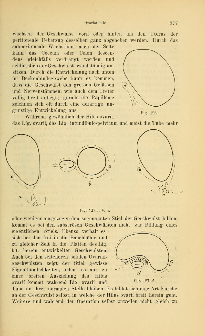 wachsen der Geschwulst vorn oder hinten um den Uterus der peritoneale Ueberzug desselben ganz abgehoben werden. Durch das subperitoneale Wachsthum nach der Seite kann das Coecum oder Colon descen- dens gleichfalls verdrängt werden und schliesslich der Geschwulst wandständig an- sitzen. Durch die Entwickelung nach unten im Beckenbindegewebe kann es kommen, dass die Geschwulst den grossen Gefässen und Nervenstämmen, wie auch dem Ureter völlig breit anliegt; gerade die Papillome zeichnen sich oft durch eine derartige un- günstige Entwickelung aus. p.^ ^26 Während gewöhnlich der Hilus ovarii, das Lig. ovarii, das Lig. infundibulo-pelvicum und meist die Tube mehr ©? 0 Ö-. Fig. 127 a, h, c. oder weniger ausgezogen den sogenannten Stiel der Geschwulst bilden, kommt es bei den subserösen Geschwülsten nicht zur Bildung eines eigentlichen Stiels. Ebenso verhält es sich bei den frei in die Bauchhöhle und zu gleicher Zeit in die Platten des Lig. lat. herein entwickelten Geschwülsten. Auch bei den selteneren soliden Ovarial- geschwülsten zeigt der Stiel gewisse Eigenthümlichkeiten, indem es nur zu einer breiten Ausziehung des Hilus ovarii kommt, während Lig. ovarii und Tube an ihrer normalen Stelle bleiben. Es bildet sich eine Art Furche an der Geschwulst selbst, in welche der Hilus ovarii breit herein geht. Weitere und während der Operation selbst zuweilen nicht gleich zu