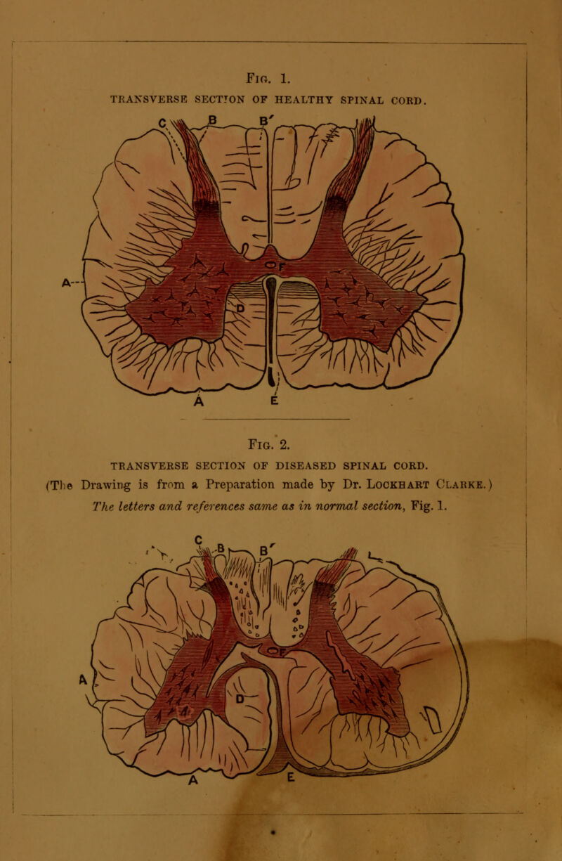 Fig. 1. transverse section of healthy spinal cord. Fig. 2. transverse section of diseased spinal cord. (The Drawing is from a Preparation made by Dr. Lockhart Clarke. The letters and references same as in normal section, Fig. 1.