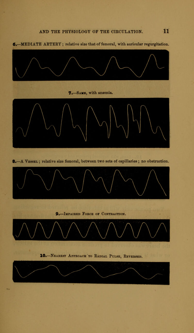 6.—MEDIATE ARTERY ; relative size that of femoral, with auricular regurgitation. 7.—Same, with ansemia. 8.—A Vessel ; relative size femoral, between two sets of capillaries ; no obstruction. 9.—Impaired Force of Contraction. 10.—Nearest Approach to Radial Pulse, Reversed.