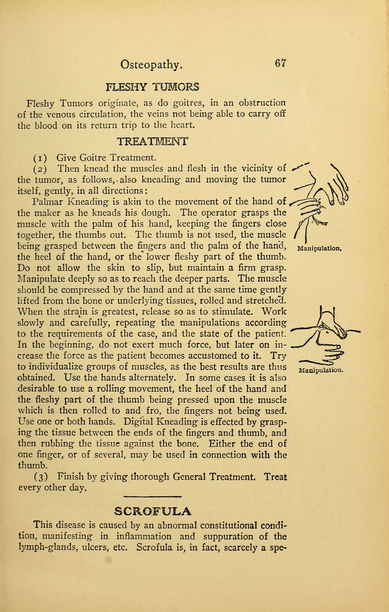 Manipulation, FLESHY TUMORS Fleshy Tumors originate, as do goitres, in an obstruction of the venous circulation, the veins not being able to carry off the blood on its return trip to the heart. TREATMENT (i) Give Goitre Treatment. (2) Then knead the muscles and flesh in the vicinity of the tumor, as follows, - also kneading and moving the tumor itself, gently, in all directions: Palmar Kneading is akin to the movement of the hand of the maker as he kneads his dough. The operator grasps the muscle v/ith the palm of his hand, keeping the fingers close together, the thumbs out. The thumb is not used, the muscle being grasped between the fingers and the palm of the hand, the heel of the hand, or the lower fleshy part of the thumb. Do not allow the skin to slip, but maintain a firm grasp. Manipulate deeply so as to reach the deeper parts. The muscle should be compressed by the hand and at the same time gently lifted from the bone or underlying tissues, rolled and stretche'3. When the stram is greatest, release so as to stimulate. Work l-s| slowly and carefully, repeating the manipulations according .^^ x_ to the requirements of the case, and the state of the patient.  J/j^^ * In the beginning, do not exert much force, but later on in- crease the force as the patient becomes accustomed to it. Try to individualize groups of muscles, as the best results are thus obtained. Use the hands alternately. In some cases it is also desirable to use a rolling movement, the heel of the hand and the fleshy part of the thumb being pressed upon the muscle which is then rolled to and fro, the fingers not being used. Use one or both hands. Digital Kneading is effected by grasp- ing the tissue between the ends of the fingers and thumb, and then rubbing the tissue against the bone. Either the end of one finger, or of several, may be used in connection with the thumb. (3) Finish by giving thorough General Treatment. Treat every other day. Maoipulatiou. SCROFULA This disease is caused by an abnormal constitutional condi- tion, manifesting in inflammation and suppuration of the lymph-glands, ulcers, etc. Scrofula is, in fact, scarcely a spe-