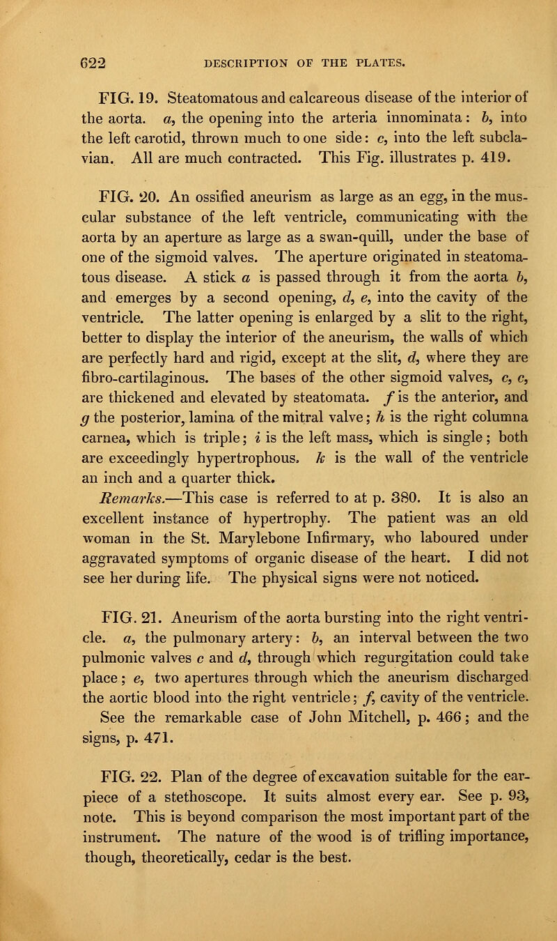 FIG. 19. Steatomatous and calcareous disease of the interior of the aorta, a, the opening into the arteria innominata: b, into the left carotid, thrown much to one side: c, into the left subcla- vian. All are much contracted. This Fig. illustrates p. 419. FIG. 20. An ossified aneurism as large as an egg, in the mus- cular substance of the left ventricle, communicating with the aorta by an aperture as large as a swan-quill, under the base of one of the sigmoid valves. The aperture originated in steatoma- tous disease. A stick a is passed through it from the aorta 6, and emerges by a second opening, d, e, into the cavity of the ventricle. The latter opening is enlarged by a slit to the right, better to display the interior of the aneurism, the walls of which are perfectly hard and rigid, except at the slit, d, where they are fibro-cartilaginous. The bases of the other sigmoid valves, c, c, are thickened and elevated by steatomata. /is the anterior, and g the posterior, lamina of the mitral valve; h is the right columna carnea, which is triple; i is the left mass, which is single; both are exceedingly hypertrophous. k is the wall of the ventricle an inch and a quarter thick. Remarks.—This case is referred to at p. 380. It is also an excellent instance of hypertrophy. The patient was an old woman in the St. Marylebone Infirmary, who laboured under aggravated symptoms of organic disease of the heart. I did not see her during life. The physical signs were not noticed. FIG. 21. Aneurism of the aorta bursting into the right ventri- cle, a, the pulmonary artery: 6, an interval between the two pulmonic valves c and d, through which regurgitation could take place; e, two apertures through which the aneurism discharged the aortic blood into the right ventricle; /, cavity of the ventricle. See the remarkable case of John Mitchell, p. 466; and the signs, p. 471. FIG. 22. Plan of the degree of excavation suitable for the ear- piece of a stethoscope. It suits almost every ear. See p. 93, note. This is beyond comparison the most important part of the instrument. The nature of the wood is of trifling importance, though, theoretically, cedar is the best.