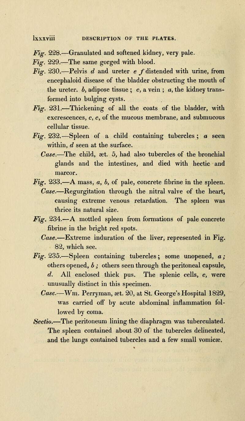 Fig. 228.—Granulated and softened kidney, very pale. Fig. 229.—The same gorged with blood. Fig. 230.—Pelvis d and ureter e /distended with urine, from encephaloid disease of the bladder obstructing the mouth of the ureter, b, adipose tissue ; c, a vein ; a, the kidney trans- formed into bulging cysts. Fig. 231.—Thickening of all the coats of the bladder, with excrescences, c, c, of the mucous membrane, and submucous cellular tissue. Fig. 232.—Spleen of a child containing tubercles ; a seen within, d seen at the surface. Case.—^The child, set. 5, had also tubercles of the bronchial glands and the intestines, and died with hectic and marcor. Fig. 233.—A mass, a, b, of pale, concrete fibrine in the spleen. Case.—Regurgitation through the nitral valve of the heart, causing extreme venous retardation. The spleen was thrice its natural size. Fig. 234.—A mottled spleen from formations of pale concrete fibrine in the bright red spots. Case.—Extreme induration of the liver, represented in Fig. 82, which see. Fig. 235.—Spleen containing tubercles ; some unopened, a; others opened, b ; others seen through the peritoneal capsule, d. All enclosed thick pus. The splenic cells, c, were unusually distinct in this specimen. Case.—Wm. Ferryman, set. 20, at St. George's Hospital 1829, was carried off by acute abdominal inflammation fol- lowed by coma. Sectio.—The peritoneum lining the diaphragm was tuberculated. The spleen contained about 30 of the tubercles delineated, and the lungs contained tubercles and a few small vomicae.