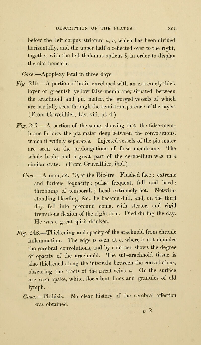 below the left corpus striatum a, e, which has been divided horizontally, and the upper half a reflected over to the right, together with the left thalamus opticus h, in order to display the clot beneath. Case.—Apoplexy fatal in three days. Fig. 246.—A portion of brain enveloped with an extremely thick layer of greenish yellow false-membrane, situated between the arachnoid and pia mater, the gorged vessels of which are partially seen through the semi-transparence of the layer. (From Cruveilhier, Liv. viii. pi. 4.) Fig. 247.—A portion of the same, showing that the false-mem- brane follows the pia mater deep between the convolutions, which it widely separates. Injected vessels of the pia mater are seen on the prolongations of false membrane. The whole brain, and a great part of the cerebellum was in a similar state. (From Cruveilhier, ibid.) Case.—A man, aet. 70, at the Bicetre. Flushed face ; extreme and furious loquacity; pulse frequent, full and hard; throbbing of temporals ; head extremely hot. Notwith- standing bleeding, &c,, he became dull, and, on the third day, fell into profound coma, with stertor, and rigid tremulous flexion of the right arm. Died during the day. He was a great spirit-drinker. Fig. 248.—^Thickening and opacity of the arachnoid from chronic inflammation. The edge is seen at c, where a slit denudes the cerebral convolutions, and by contrast shows the degree of opacity of the arachnoid. The sub-arachnoid tissue is also thickened along the intervals between the convolutions, obscuring the tracts of the great veins a. On the surface are seen opake, white, flocculent lines and granules of old lymph. Case.—Phthisis. No clear history of the cerebral affection was obtained. f 2