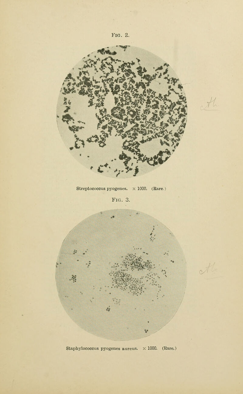 streptococcus pyogenes, x 1000. (Rare.) Fig. 3. •. •:>-V..»t.'--'-' staphylococcus pyogenes aureus, x 1000. (Rare.)