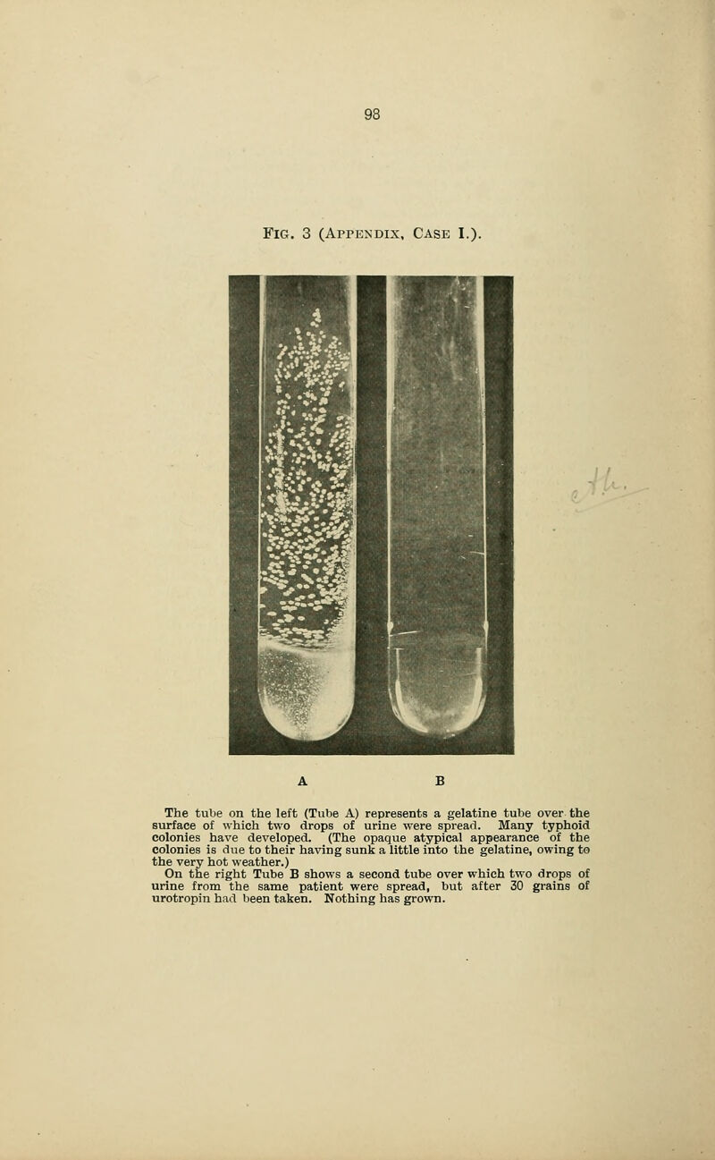Fig. 3 (Appendix, Case I.). B The tube on the left (Tube A) represents a gelatine tube over the surface of which two drops of urine were spread. Many typhoid colonies have developed. (The opaque atypical appearance of the colonies is due to their having sunk a little into the gelatine, owing to the very hot weather.) On the right Tube B shows a second tube over which two drops of urine from the same patient were spread, but after 30 grains of urotropin had been taken. Nothing has grown.