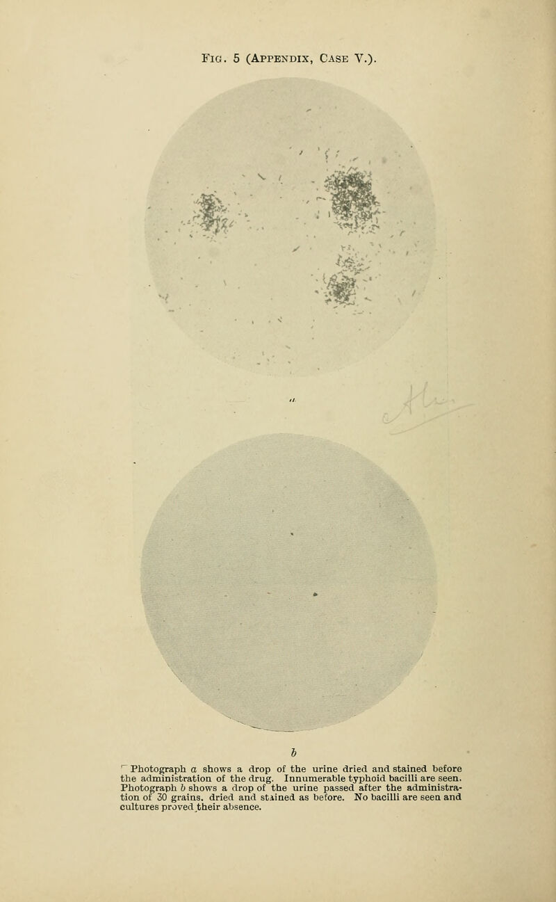 ■ Photograph o shows a drop of the urine dried and stained before the administration of the drug. Innumerable typhoid bacilli are seen. Photograph b shows a drop of the urine passed after the administra- tion of 30 grains, dried and stiined as before. No bacilli are seen and cultures proved their absence.