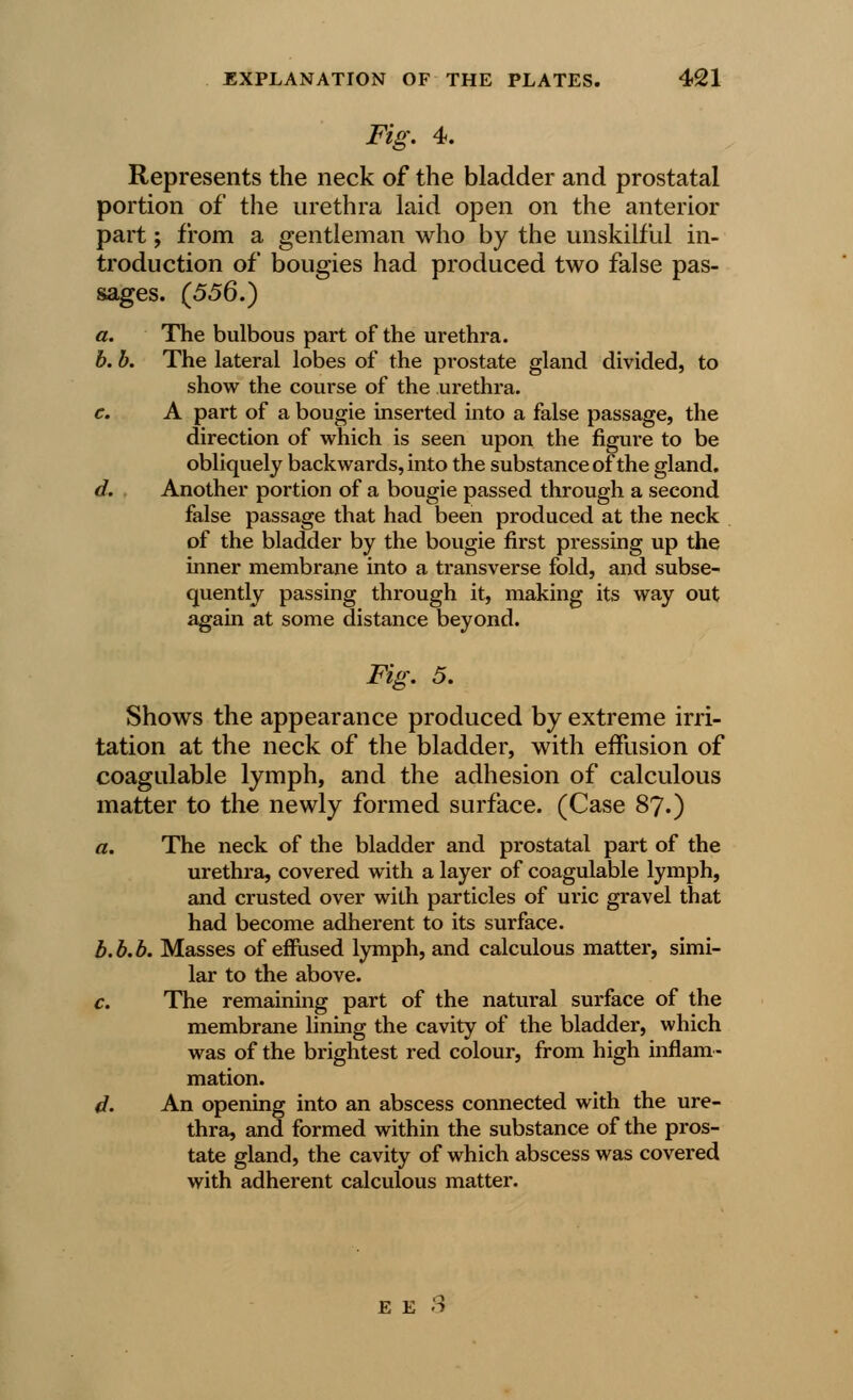 Fig. 4. Represents the neck of the bladder and prostatal portion of the urethra laid open on the anterior part; from a gentleman who by the unskilful in- troduction of bougies had produced two false pas- sages. (556.) a. The bulbous part of the urethra. b. b. The lateral lobes of the prostate gland divided, to show the course of the urethra. c. A part of a bougie inserted into a false passage, the direction of which is seen upon the figure to be obliquely backwards, into the substance of the gland. d. Another portion of a bougie passed through a second false passage that had been produced at the neck of the bladder by the bougie first pressing up the inner membrane into a transverse fold, and subse- quently passing through it, making its way out again at some distance beyond. Fig. 5. Shows the appearance produced by extreme irri- tation at the neck of the bladder, with effusion of coagulable lymph, and the adhesion of calculous matter to the newly formed surface. (Case 87.) a. The neck of the bladder and prostatal part of the urethra, covered with a layer of coagulable lymph, and crusted over with particles of uric gravel that had become adherent to its surface. b.b.b. Masses of efrused lymph, and calculous matter, simi- lar to the above. c. The remaining part of the natural surface of the membrane lining the cavity of the bladder, which was of the brightest red colour, from high inflam- mation. d. An opening into an abscess connected with the ure- thra, and formed within the substance of the pros- tate gland, the cavity of which abscess was covered with adherent calculous matter.
