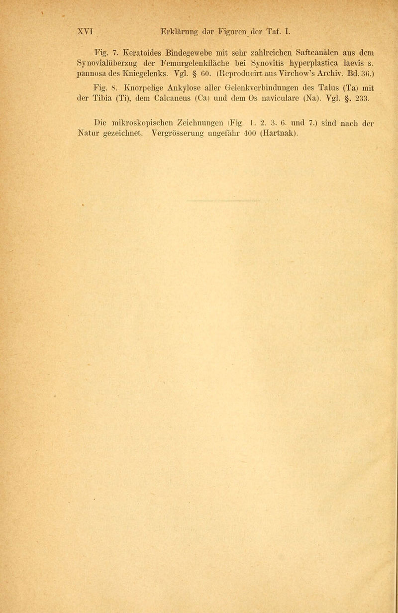 Fig. 7. Keratoides Bindegewebe mit selir zahlreichen Saftcanälen aus dem Synovialüberzug der Femurgelenkfläche hei Synovitis hyperplastica laevis s. pannosa des Kniegelenks. Vgl. § 60. (Reproducirt aus Virchow's Archiv. Bd. 30.) Fig. S. Knorpehge Ankylose aller Grelenkverbinduugen des Talus (Ta) mit der Tibia (Ti), dem Calcaneus (Ca) und dem Os naviculare (Na). Vgl. §. 233. Die mikroskopischen Zeichnungen (Fig. 1. 2. 3. 6. und 7.) sind nach der Natur gezeichnet. Vergrösserung ungefähr 400 (Hartnak).