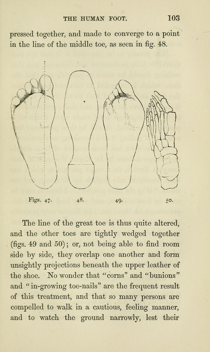 pressed together, and made to converge to a point in the line of the middle toe, as seen in fig. 48. Figs. 4^ 48. 49. 50- The line of the great toe is thus quite altered, and the other toes are tightly wedged together (figs. 49 and 50); or, not being able to find room side by side, they overlap one another and form unsightly projections beneath the upper leather of the shoe. No wonder that ^^corns and bunions and in-growing toe-nails are the frequent result of this treatment, and that so many persons are compelled to walk in a cautious, feeling manner, and to watch the ground narrowly, lest their