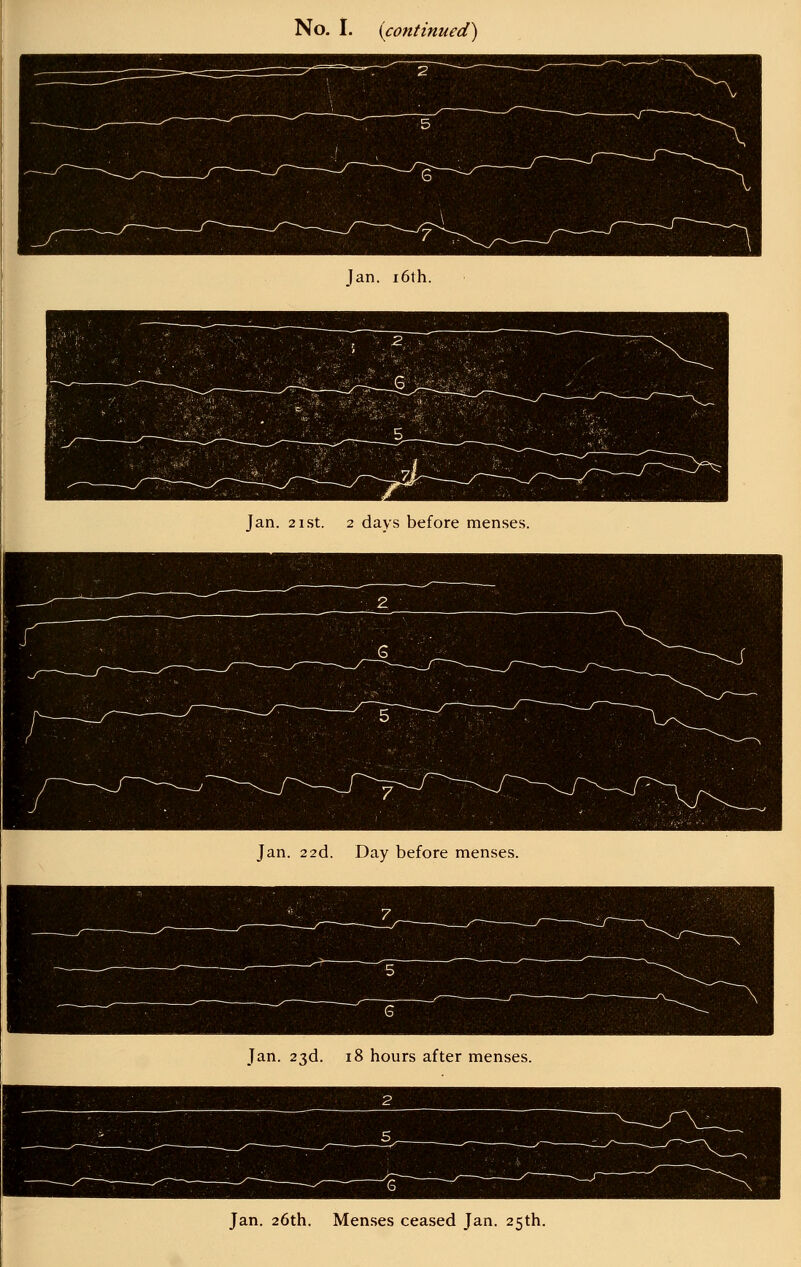 Jan. i6th. Jan. 21 St. 2 days before menses. Jan. 22d. Day before menses. Jan. 23d. 18 hours after menses. Jan. 26th. Men.ses ceased Jan. 25th.
