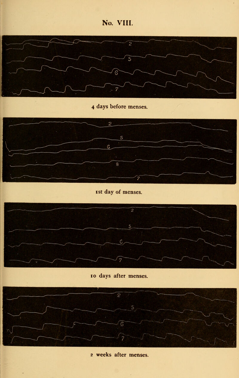 No. VIII. 4 days before menses. I St day of menses. lo days after menses. 2 weeks after menses.