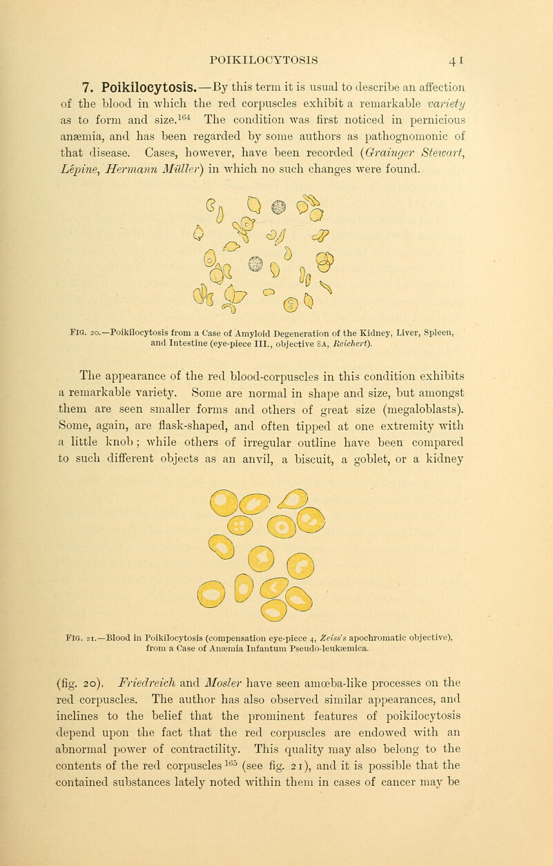 7. PoikilOCytOSiS.—By this term it is usual to describe an affection of the blood in which the red corpuscles exhibit a remarkable variety as to form and size.164 The condition was first noticed in pernicious anaemia, and has been regarded by some authors as pathognomonic of that disease. Cases, however, have been recorded {Grainger Steioart, Lepine, Hermann Mutter) in which no such changes were found. 0 If 4/'. + h ©0 o ! S FIG. 2o.—Poikilocytosis from a Case of Amyloid Degeneration of the Kidney, Liver, Spleen, and Intestine (eye-piece III., objective 8A, Reichert). The appearance of the red blood-corpuscles in this condition exhibits a remarkable variety. Some are normal in shape and size, but amongst them are seen smaller forms and others of great size (megaloblasts). Some, again, are flask-shaped, and often tipped at one extremity with a little knob ; while others of irregular outline have been compared to such different objects as an anvil, a biscuit, a goblet, or a kidney pfcP Pig. 2i.—Blood in Poikilocytosis (compensation eye-piece 4, Zeiss's apochromatic objective), from a Case of Anaemia Infantum Pseudo-leukfemica. (fig. 20). Friedreich and Hosier have seen amceba-like processes on the red corpuscles. The author has also observed similar appearances, and inclines to the belief that the prominent features of poikilocytosis depend upon the fact that the red corpuscles are endowed with an abnormal power of contractility. This quality may also belong to the contents of the red corpuscles165 (see fig. 21), and it is possible that the contained substances lately noted within them in cases of cancer may be