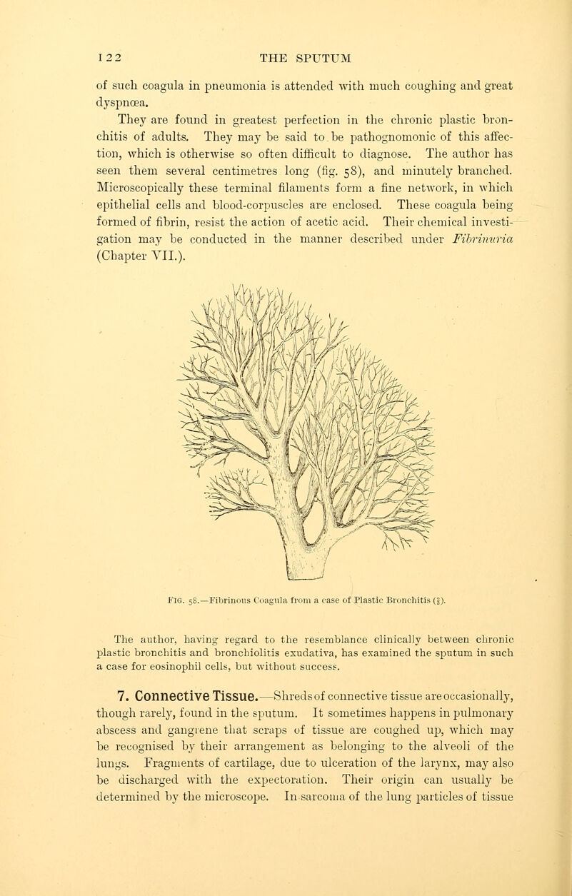 of such, coagula in pneumonia is attended with much coughing and great dyspnoea. They are found in greatest perfection in the chronic plastic bron- chitis of adults. They may be said to he pathognomonic of this affec- tion, which is otherwise so often difficult to diagnose. The author has seen them several centimetres long (fig. 58), and minutely branched. Microscopically these terminal filaments form a fine network, in which epithelial cells and blood-corpuscles are enclosed. These coagula being- formed of fibrin, resist the action of acetic acid. Their chemical investi- gation may be conducted in the manner described under Fibrimiria (Chapter VII.). Vhi Fig. 58.—Fibrinous Coagula from a case of Plastic Bronchitis (§). The author, having regard to the resemblance clinically between chronic plastic bronchitis and bronchiolitis exudativa, has examined the sputum in such a case for eosinophil cells, but without success. 7. Connective Tissue.—Shreds of connective tissue are occasionally, though rarely, found in the sputum. It sometimes happens in pulmonary abscess and gangrene that scraps of tissue are coughed up, which may be recognised by their arrangement as belonging to the alveoli of the lungs. Fragments of cartilage, due to ulceration of the larynx, may also be discharged with the expectoration. Their origin can usually be determined by the microscope. In sarcoma of the lung particles of tissue