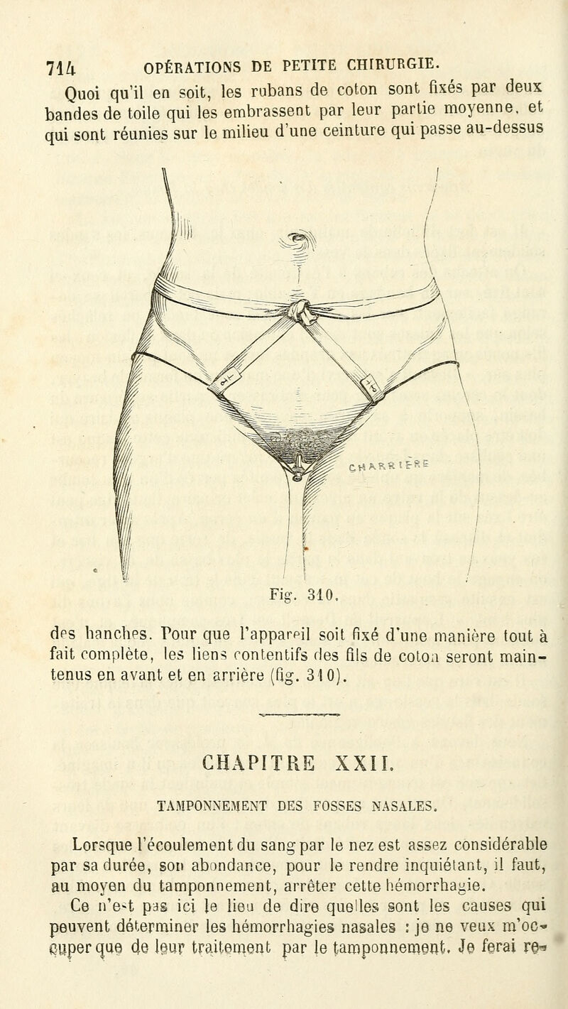 Quoi qu'il en soit, les rubans de coton sont fixés par deux bandes de toile qui les embrassent par leur partie moyenne, et qui sont réunies sur le milieu d'une ceinture qui passe au-dessus Fig-. 310. dps lianchps. Pour que Tapparpil soit fixé d'une manière tout à fait complète, les liens rontentifs des fils de colon seront main- tenus en avant et en arrière (fig. 310). CHAPITRE XXÎL TAMPONxNEMENT DES FOSSES NASALES. Lorsque l'écoulement du sang par le nez est assez considérable par sa durée, son abondance, pour le rendre inquiétant, il faut, au moyen du tamponnement, arrêter cette hémorrhagie. Ce n'e-t pas ici le lieu de dire quelles §ont les causes qui peuvent déterminer les hémorrhagies nasales : je ne veux m'oC' quperque cfe leur traitement par le taroponnemeat. Je ferai re-*