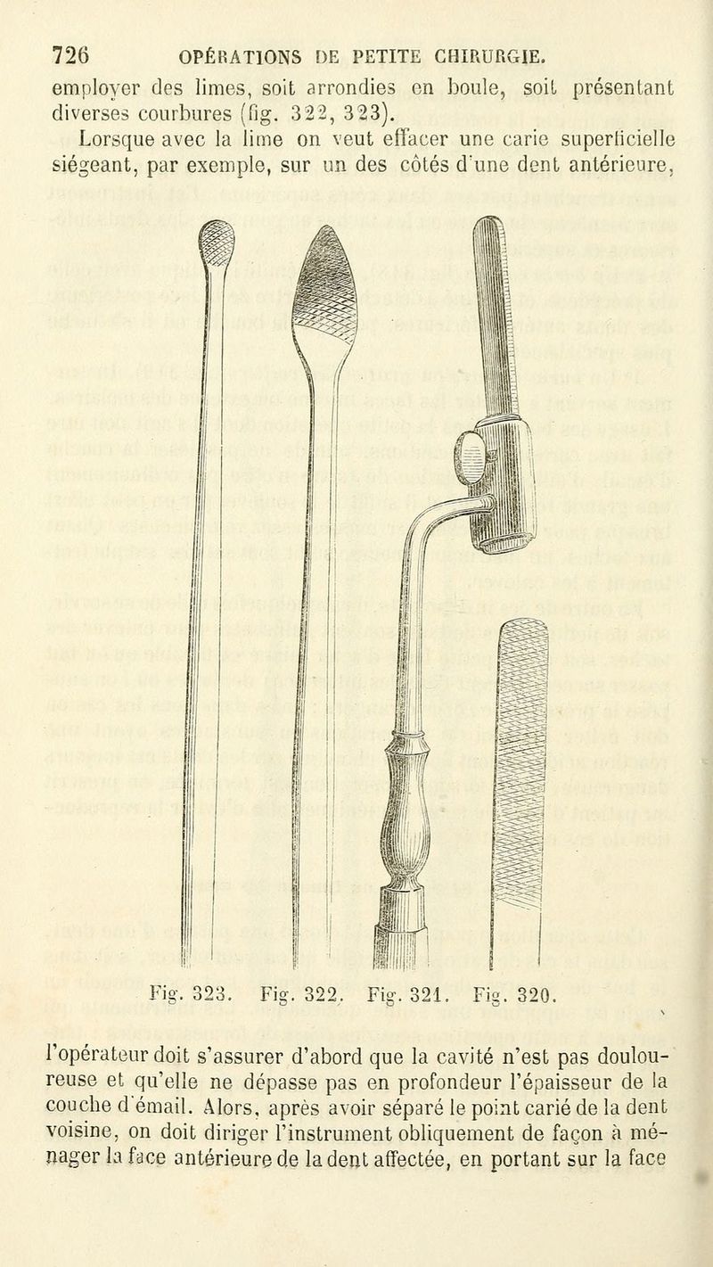employer des limes, soit arrondies en boule, soil présentant diverses courbures (fig. 322, 323). Lorsque avec la lime on veut effacer une carie superticielle siégeant, par exemple, sur un des côtés d'une dent antérieure, Fig. 323. Fig. 322. Fig. 321. Fig. 320. l'opérateur doit s'assurer d'abord que la cavité n'est pas doulou- reuse et qu'elle ne dépasse pas en profondeur l'épaisseur de la couche demail. Alors, après avoir séparé le point carié de la dent voisine, on doit diriger l'instrument obliquement de façon à mé- nager la face antérieure de la dent affectée, en portant sur la face