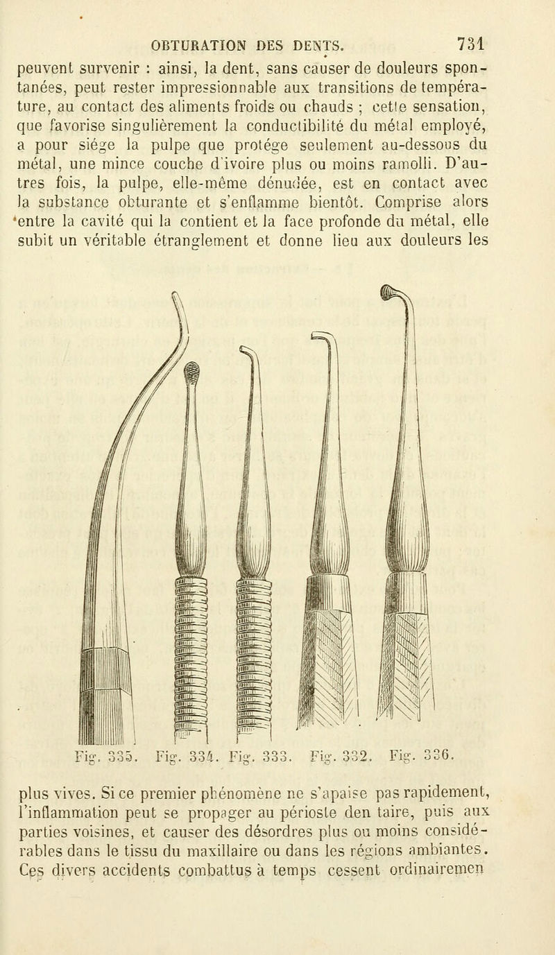 peuvent survenir : ainsi, la dent, sans causer de douleurs spon- tanées, peut rester impressionnable aux transitions de tempéra- ture, au contact des aliments froids ou chauds ; cetle sensation, que favorise singulièrement la conductibilité du métal employé, a pour siège la pulpe que protège seulement au-dessous du métal, une mince couche d'ivoire plus ou moins ramolli. D'au- tres fois, la pulpe, elle-même dénudée, est en contact avec la substance obturante et s'enflamme bientôt. Comprise alors 'entre la cavité qui la contient et la face profonde du métal, elle subit un véritable étranglement et donne lieu aux douleurs les plus vives. Si ce premier phénomène ne s'apaise pas rapidement, l'inflammation peut se propager au périoste den taire, puis aux parties voisines, et causer des désordres plus ou moins considé- rables dans le tissu du maxillaire ou dans les régions ambiantes. Ces divers accidents combattus à temps cessent ordinairemen