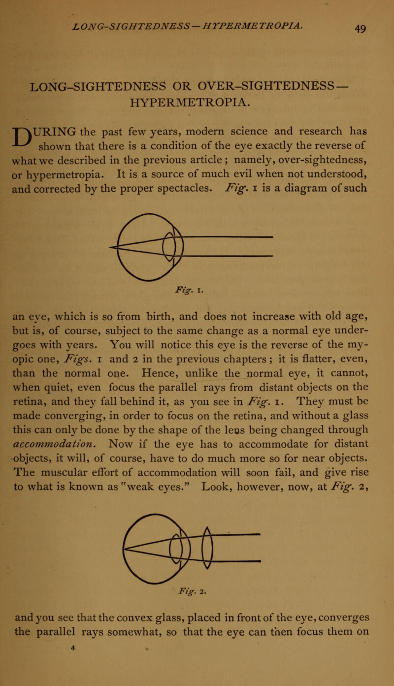 LONG-SIGHTEDNESS OR OVER-SIGHTEDNESS — HYPERMETROPIA. POURING the past few years, modern science and research has --^ shown that there is a condition of the eye exactly the reverse of what we described in the previous article; namely, over-sightedness, or hypermetropia. It is a source of much evil when not understood, and corrected by the proper spectacles. Fig. 1 is a diagram of such Fig. 1. an eye, which is so from birth, and does not increase with old age, but is, of course, subject to the same change as a normal eye under- goes with years. You will notice this eye is the reverse of the my- opic one, Figs. 1 and 2 in the previous chapters; it is flatter, even, than the normal one. Hence, unlike the normal eye, it cannot, when quiet, even focus the parallel rays from distant objects on the retina, and they fall behind it, as you see in Fig. 1. They must be made converging, in order to focus on the retina, and without a glass this can only be done by the shape of the lens being changed through accom?nodation. Now if the eye has to accommodate for distant -objects, it will, of course, have to do much more so for near objects. The muscular effort of accommodation will soon fail, and give rise to what is known as weak eyes. Look, however, now, at Fig. 2, Fig. 2. and you see that the convex glass, placed in front of the eye, converges the parallel rays somewhat, so that the eye can then focus them on