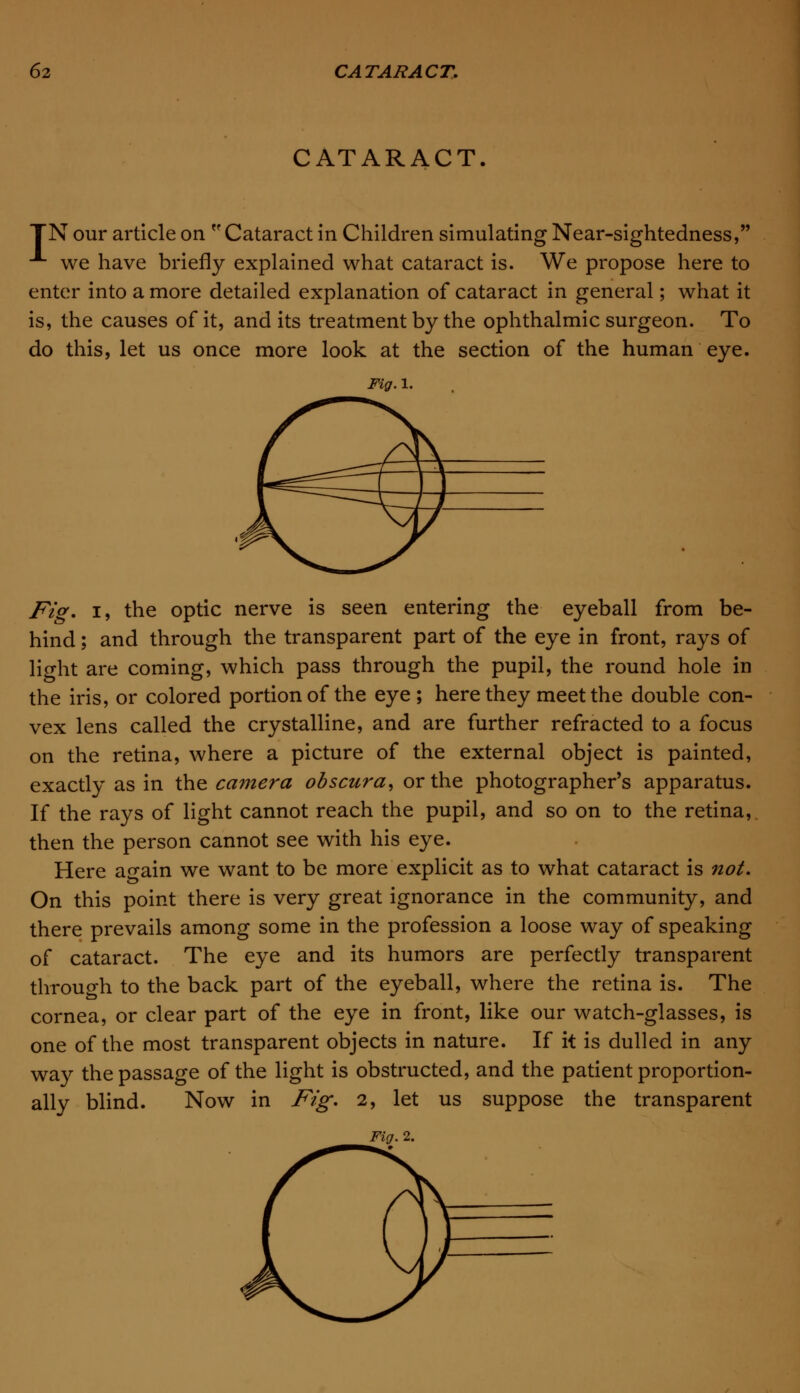 CATARACT. TN our article on Cataract in Children simulating Near-sightedness, A we have briefly explained what cataract is. We propose here to enter into a more detailed explanation of cataract in general; what it is, the causes of it, and its treatment by the ophthalmic surgeon. To do this, let us once more look at the section of the human eye. Fig. 1. Fig. i, the optic nerve is seen entering the eyeball from be- hind ; and through the transparent part of the eye in front, rays of light are coming, which pass through the pupil, the round hole in the iris, or colored portion of the eye; here they meet the double con- vex lens called the crystalline, and are further refracted to a focus on the retina, where a picture of the external object is painted, exactly as in the ca?nera odscura, or the photographer's apparatus. If the rays of light cannot reach the pupil, and so on to the retina,, then the person cannot see with his eye. Here again we want to be more explicit as to what cataract is not. On this point there is very great ignorance in the community, and there prevails among some in the profession a loose way of speaking of cataract. The eye and its humors are perfectly transparent through to the back part of the eyeball, where the retina is. The cornea, or clear part of the eye in front, like our watch-glasses, is one of the most transparent objects in nature. If it is dulled in any way the passage of the light is obstructed, and the patient proportion- ally blind. Now in Fig. 2, let us suppose the transparent Fig. 2.