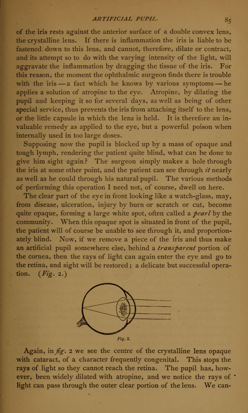 of the iris rests against the anterior surface of a double convex lens, the crystalline lens. If there is inflammation the iris is liable to be fastened down to this lens, and cannot, therefore, dilate or contract, and its attempt so to do with the varying intensity of the light, will aggravate the inflammation by dragging the tissue of the iris. For this reason, the moment the ophthalmic surgeon finds there is trouble with the iris—a fact which he knows by various symptoms — he applies a solution of atropine to the eye. Atropine, by dilating the pupil and keeping it so for several days, as well as being of other special service, thus prevents the iris from attaching itself to the lens, or the little capsule in which the lens is held. It is therefore an in- valuable remedy as applied to the eye, but a powerful poison when internally used in too large doses. Supposing now the pupil is blocked up by a mass of opaque and tough lymph, rendering the patient quite blind, what can be done to give him sight again? The surgeon simply makes a hole through the iris at some other point, and the patient can see through it nearly as well as he could through his natural pupil. The various methods of performing this operation I need not, of course, dwell on here. The clear part of the eye in front looking like a watch-glass, may, from disease, ulceration, injury by burn or scratch or cut, become quite opaque, forming a large white spot, often called a. pearl by the community. When this opaque spot is situated in front of the pupil, the patient will of course be unable to see through it, and proportion- ately blind. Now, if we remove a piece of the iris and thus make an artificial pupil somewhere else, behind a transparent portion of the cornea, then the rays of light can again enter the eye and go to the retina, and sight will be restored ; a delicate but successful opera- tion. {Fig. 2.) Fig. 2. Again, in Jig. 2 we see the centre of the crystalline lens opaque with cataract, of a character frequently congenital. This stops the rays of light so they cannot reach the retina. The pupil has, how- ever, been widely dilated with atropine, and we notice the rays of light can pass through the outer clear portion of the lens. We can-
