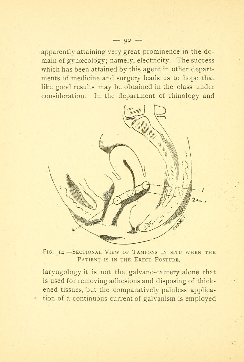 — 9° — apparently attaining very great prominence in the do- main of gynaecology; namely, electricity. The success which has been attained by this agent in other depart- ments of medicine and surgery leads us to hope that like good results may be obtained in the class under consideration. In the department of rhinology and Fig. 14.—Sectional View of Tampons in situ when the Patient is in the Erect Posture. laryngology it is not the galvano-cautery alone that is used for removing adhesions and disposing of thick- ened tissues, but the comparatively painless applica- tion of a continuous current of galvanism is employed