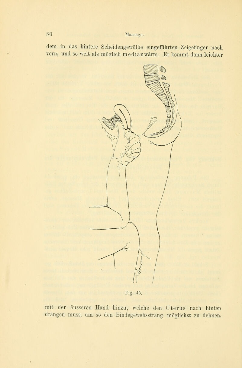 dem in das hintere Scheidengewölbe eingeführten Zeigefinger nach vorn, und so weit als möglich medianwärts. Er kommt dann leichter Fig. 45. mit der äusseren Hand hinzu, welche den Uterus nach hinten drängen muss, um so den Bindegewebsstrang möglichst zu dehnen.