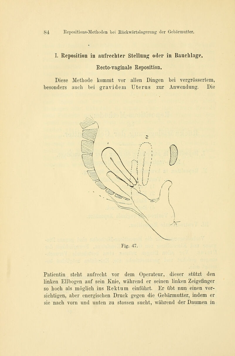 I. Reposition in aufrecMer Stellung oder in Bauclilage. Eecto-vaginale Reposition. Diese Methode konimt vor allen Dingen bei vergrössertem, besonders auch bei gravidem Uterus zur Anwendung. Die Fig. 47. Patientin steht aufrecht vor dem Operateur, dieser stützt den linken Ellbogen auf sein Knie, während er seinen linken Zeigefinger so hoch als möglich ins Rektum einführt. Er übt nun einen vor- sichtigen, aber energischen Druck gegen die Gebärmutter, indem er sie nach vorn und unten zu stossen sucht, während der Daumen in