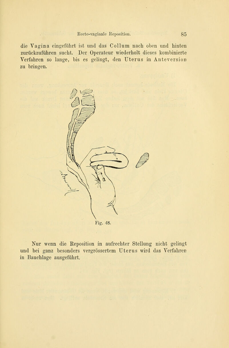 die Vagina eingeführt ist und das Collum nach oben und hinten zurückzuführen sucht. Der Operateur wiederholt dieses kombinierte Verfahren so lange, bis es gelingt, den Uterus in Anteversion zu brinoren. Fig. 48. Nur wenn die Eeposition in aufrechter Stellung nicht gelingt und bei ganz besonders vergrössertem Uterus wird das Verfahren in Bauchlage ausgeführt.