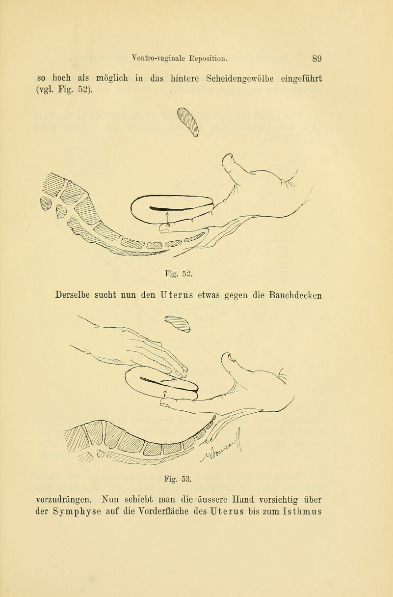 SO hoch als möglich in das hintere Scheidengewölbe eingeführt (vgl. Fig. 52). Piff. 52. Derselbe sucht nun den Uterus etwas gegen die Bauchdecken Fiff. 53. vorzudrängen. Nun schiebt man die äussere Hand vorsichtig über der Symphyse auf die Vorderfläche des Uterus bis zum Isthmus