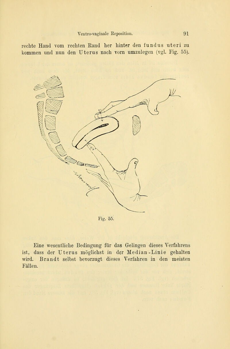 recMe Hand vom rechten Eaud her hinter den fundus nteri zu kommen und nun den Uterus nach vorn umzulegen (vgl. Fig. 55). Fig. 55. Eine wesentliche Bedingung für das Gelingen dieses Verfahrens ist, dass der Uterus möglichst in der Median-Linie gehalten wird. Brandt selbst bevorzugt dieses Verfahren in den meisten Fällen.