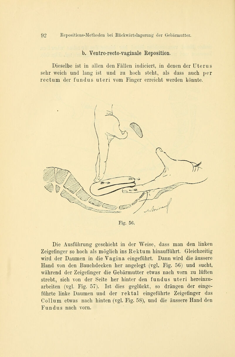 b. Ventro-recto-vaginale Reposition. Dieselbe ist in allen den Fällen indiciert, in denen der Uterus sehr weich und lang ist und zu hocb steht, als dass auch per rectum der fundus uteri vom Finger erreicht werden könnte. Fig. 56. Die Ausführung geschieht in der Weise, dass man den linken Zeigefinger so hoch als möglich ins Rektum hinaufführt. Gleichzeitig wird der Daumen in die Vagina eingeführt. Dann wird die äussere Hand von den Bauchdecken her angelegt (vgl. Fig. 56) und sucht, während der Zeigefinger die Gebärmutter etwas nach vorn zu lüften strebt, sich von der Seite her hinter den fundus uteri hereinzu- arbeiten (vgl. Fig. 57). Ist dies geglückt, so drängen der einge- führte linke Daumen und der rektal eingeführte Zeigefinger das Collum etwas nach hinten (vgl. Fig. 58), und die äussere Hand den Fundus nach vorn.