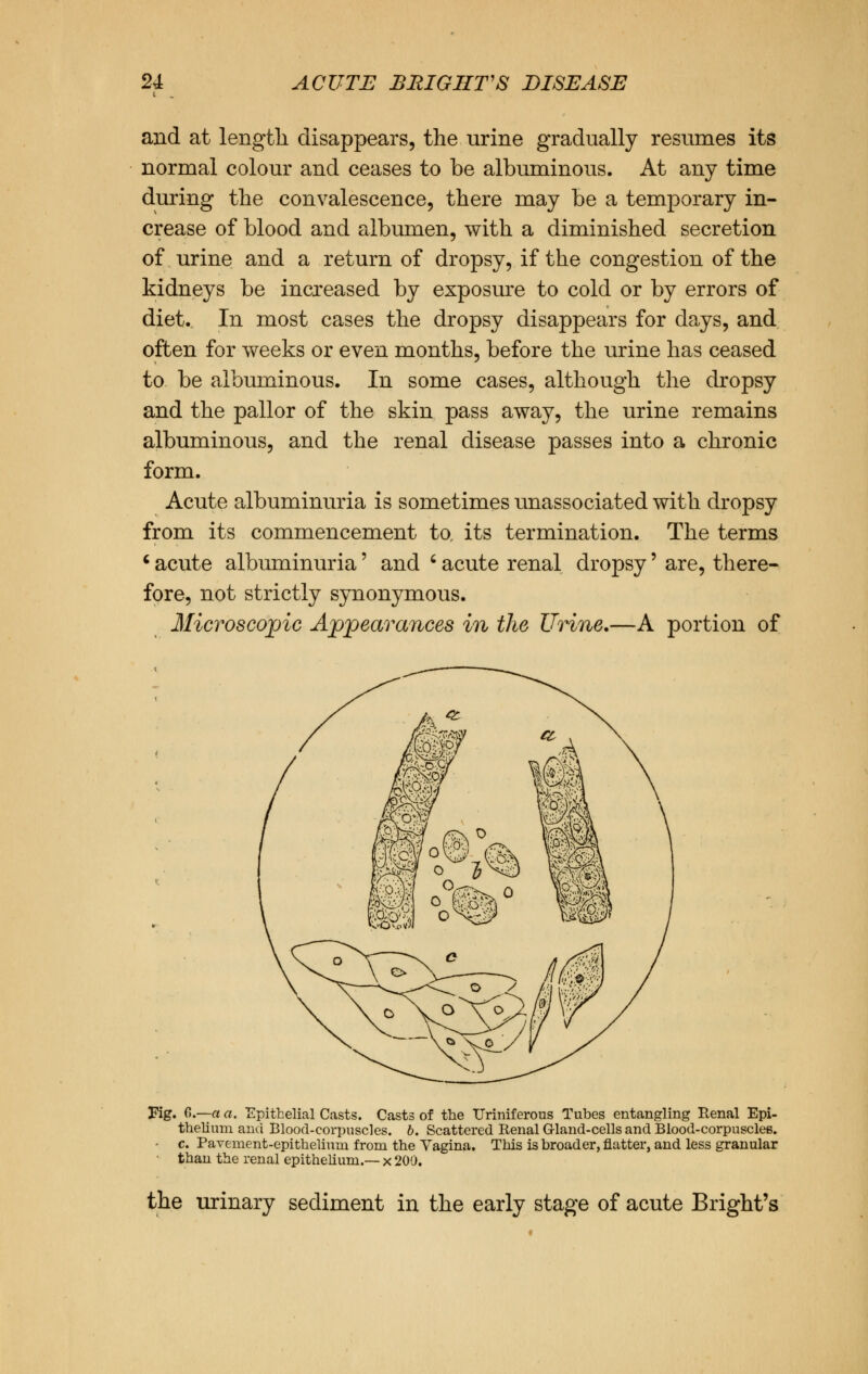 and at length disappears, the urine gradually resumes its normal colour and ceases to be albuminous. At any time during the convalescence, there may be a temporary in- crease of blood and albumen, with a diminished secretion of urine and a return of dropsy, if the congestion of the kidneys be increased by exposure to cold or by errors of diet. In most cases the dropsy disappears for days, and often for weeks or even months, before the urine has ceased to be albuminous. In some cases, although the dropsy and the pallor of the skin pass away, the urine remains albuminous, and the renal disease passes into a chronic form. Acute albuminuria is sometimes unassociated with dropsy from its commencement to, its termination. The terms 1 acute albuminuria' and ' acute renal dropsy' are, there- fore, not strictly synonymous. Microscopic Appearances in the Urine.—A portion of Fig. 6.—a a. Epithelial Casts. Casts of the Uriniferous Tubes entangling Renal Epi- thelium and Blood-corpuscles, b. Scattered Renal G-land-cells and Blood-corpuscles. c. Pavement-epithelium from the Vagina. This is broader, natter, and less granular than the renal epithelium.— x 200. the urinary sediment in the early stage of acute Bright's