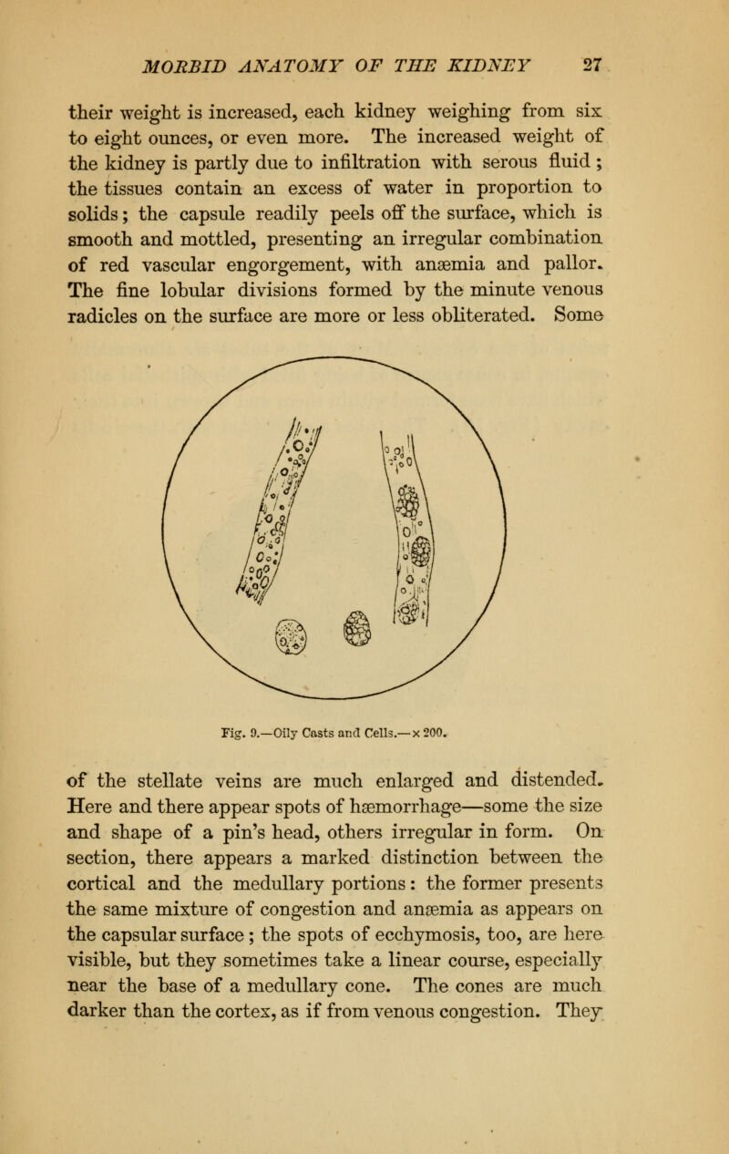 their weight is increased, each kidney weighing from six to eight ounces, or even more. The increased weight of the kidney is partly due to infiltration with serous fluid ; the tissues contain an excess of water in proportion to solids; the capsule readily peels off the surface, which is smooth and mottled, presenting an irregular combination of red vascular engorgement, with anaemia and pallor* The fine lobular divisions formed by the minute venous radicles on the surface are more or less obliterated. Some Fig. 9.—Oily Casts and Cells.—x 200. of the stellate veins are much enlarged and distended. Here and there appear spots of haemorrhage—some the size and shape of a pin's head, others irregular in form. On section, there appears a marked distinction between the cortical and the medullary portions: the former presents the same mixture of congestion and anaemia as appears on the capsular surface; the spots of ecchymosis, too, are here visible, but they sometimes take a linear course, especially near the base of a medullary cone. The cones are much darker than the cortex, as if from venous congestion. They