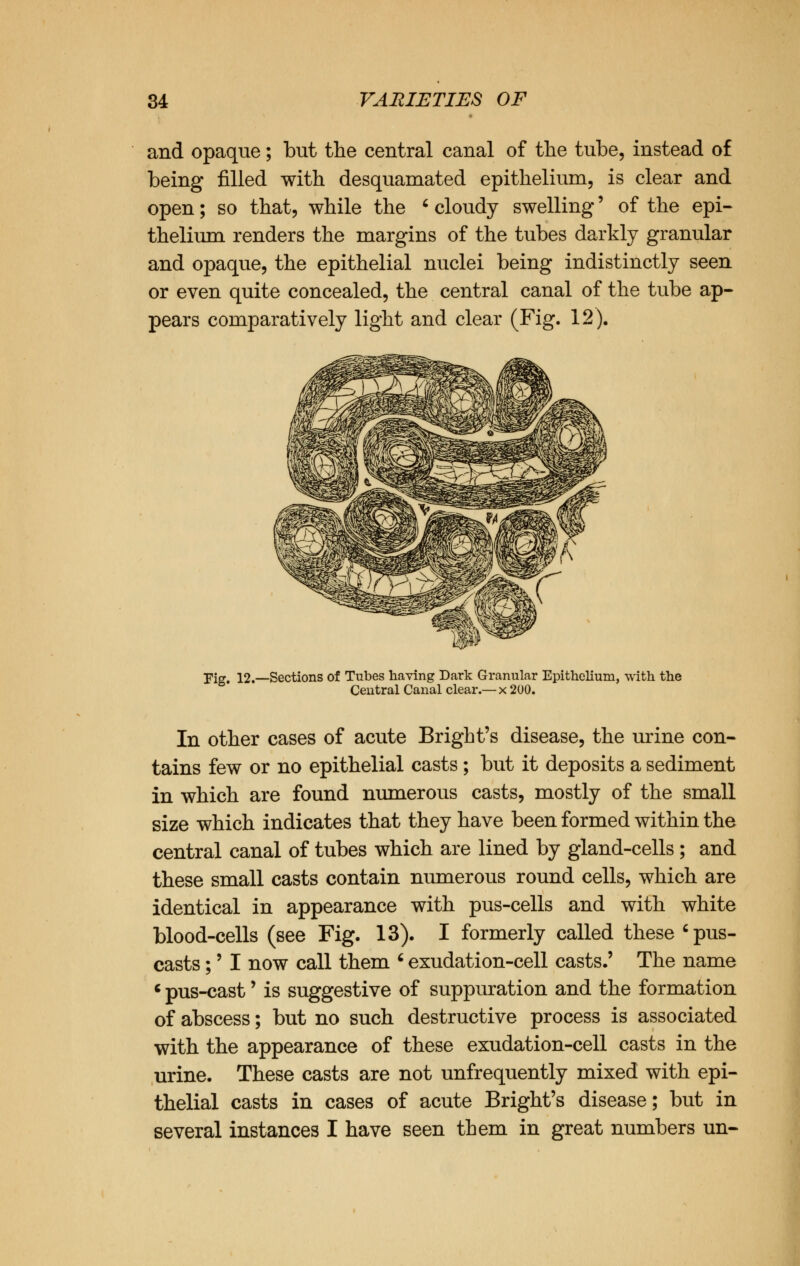 and opaque; but the central canal of the tube, instead of being filled with desquamated epithelium, is clear and open; so that, while the ' cloudy swelling' of the epi- thelium renders the margins of the tubes darkly granular and opaque, the epithelial nuclei being indistinctly seen or even quite concealed, the central canal of the tube ap- pears comparatively light and clear (Fig. 12). Fig. 12.—Sections of Tubes having Dark Granular Epithelium, with the Central Canal clear.—x 200. In other cases of acute Bright's disease, the urine con- tains few or no epithelial casts ; but it deposits a sediment in which are found numerous casts, mostly of the small size which indicates that they have been formed within the central canal of tubes which are lined by gland-cells; and these small casts contain numerous round cells, which are identical in appearance with pus-cells and with white blood-cells (see Fig. 13). I formerly called these c pus- casts ;' I now call them * exudation-cell casts.' The name 6 pus-cast' is suggestive of suppuration and the formation of abscess; but no such destructive process is associated with the appearance of these exudation-cell casts in the urine. These casts are not unfrequently mixed with epi- thelial casts in cases of acute Bright's disease; but in several instances I have seen them in great numbers un-
