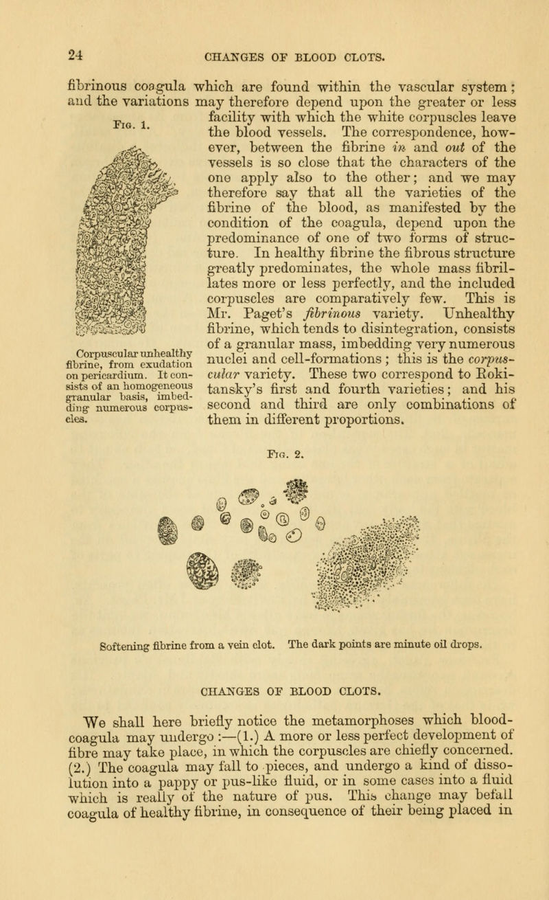 fibrinous coagula and the variations Fig. 1. Corpuscular imlaealthy fibrine, from exudation on pericardium. It con- sists of an homog-eneous granular basis, imbed- ding' numerous corpus- cles. which are found within the vascular system; may therefore depend upon the greater or less facility with which the white corpuscles leave the blood vessels. The correspondence, how- ever, between the fibrine in and out of the vessels is so close that the characters of the one apply also to the other; and we may therefore say that all the varieties of the fibrine of the blood, as manifested by the condition of the coagula, depend upon the predominance of one of two forms of struc- ture. In healthy fibrine the fibrous structure greatly predominates, the whole mass fibril- lates more or less perfectly, and the included corpuscles are comparatively few. This is Mr. Paget's fibrinous variety. Unhealthy fibrine, which tends to disintegration, consists of a granular mass, imbedding very numerous nuclei and cell-formations ; this is the corpus- cular variety. These two correspond to Eoki- tansky's first and fourth varieties; and his second and third are only combinations of them in different proportions. Fig. 2. v5i *^t° e .^^•^^ Softening fibrine from a vein clot. The dark i)oints are minute oil drops. CHANGES OF BLOOD CLOTS. We shall here briefly notice the metamorphoses which blood- coagula may undergo :—(1.) A more or less perfect development of fibre may take place, in which the corpuscles are chiefly concerned. (2.) The coagula may fall to pieces, and undergo a kmd of disso- lution into a pappy or pus-like fluid, or in some cases into a fluid which is really of the nature of pus. Thib change may befall coagula of healthy fibrine, in consequence of their bemg placed in