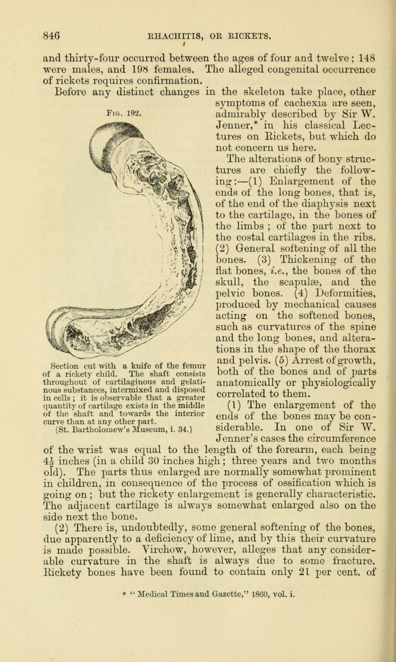 and thirty-four occurred between the ages of four aad twelve were males, and 198 females. — -- - of rickets requires confirmation Before any distinct changes 148 The alleged congenital occurrence Fig. 192. in the skeleton take place, other symptoms of cachexia are seen, admirably described by Sir W. Jenner,* in his classical Lec- tures on Eickets, but which do not concern us here. The alterations of bony struc- tures are chiefly the follow- ing:—(1) Enlargement of the ends of the long bones, that is, of the end of the diaphysis next to the cartilage, in the bones of the limbs ; of the part next to the costal cartilages in the ribs. (2) General softening of all the bones. (3) Thickening of the flat bones, i.e., the bones of the skull, the scapulae, and the jDclvic boneSc (4) Deformities, produced by mechanical causes acting on the softened bones, such as curvatures of the spine and the long bones, and altera- tions in the shape of the thorax and pelvis. (5) Arrest of growth, both of the bones and of parts anatomically or physiologically correlated to them. (1) The enlargement of the ends of the bones may be con- siderable. In one of Sir W. Jenner's cases the circumference of the wrist was equal to the length of the forearm, each being 4J inches (in a child 30 inches high; three years and two months old). The parts thus enlarged are normally somewhat prominent in children, in consequence of the process of ossification which is going on; but the rickety enlargement is generally characteristic. The adjacent cartilage is always somewhat enlarged also on the side next the bone. (2) There is, undoubtedly, some general softening of the bones, due apparently to a deficiency of lime, and by this their curvature is made possible. Virchow, however, alleges that any consider- able curvature in the shaft is always due to some fracture. Kickety bones have been found to contain only 21 per cent, of Section cut with a knife of the femur of a rickety child. The shaft consists throughout of cartilaginous and gelati- nous substances, intermixed and disposed in cells ; it is observable that a greater quantity of cartilage exists in the middle of the shaft and towards the interior curve than at any other part. (St. Bartholomew's Museum, i. 34.) *  Medical Times and Gazette, 1860, vol.