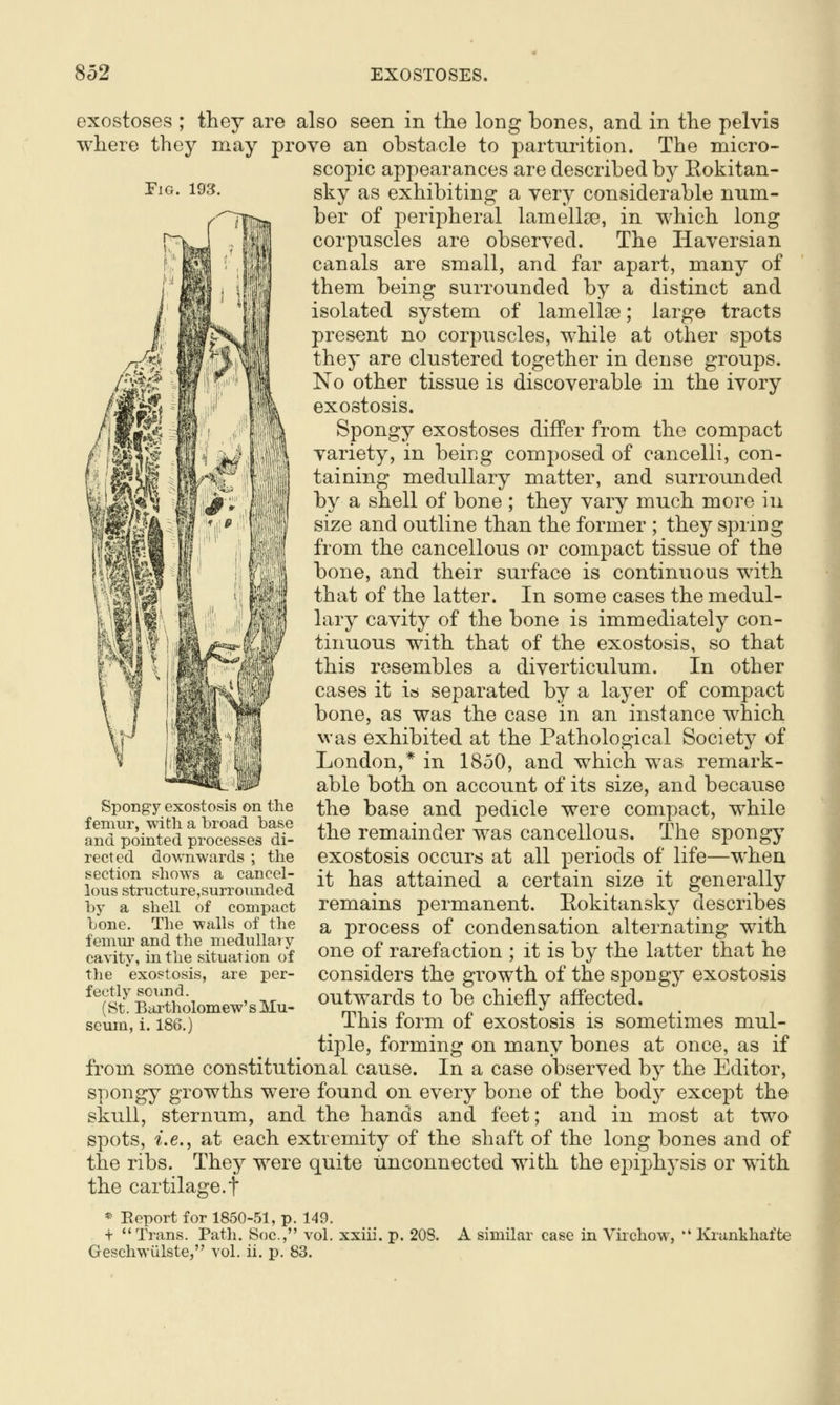 EiG. 193. exostoses ; they are also seen in the long bones, and in the pelvis where they may prove an obstacle to parturition. The micro- scopic appearances are described by Eokitan- sky as exhibiting a very considerable num- ber of peripheral lamellge, in which long corpuscles are observed. The Haversian canals are small, and far apart, many of them being surrounded by a distinct and isolated system of lamellae; large tracts present no corpuscles, while at other spots they are clustered together in dense groups. fit'' ui iiim ^^ other tissue is discoverable in the ivory Mi 'm:/ ^m exostosis. ^ ?m'''; ''''||i| Spoi^&y exostoses differ from the compact   ■ variety, in being composed of cancelli, con- taining medullary matter, and surrounded by a shell of bone ; they vary much more in size and outline than the former ; they spring from the cancellous or compact tissue of the bone, and their surface is continuous with that of the latter. In some cases the medul- lary cavity of the bone is immediately con- tinuous with that of the exostosis, so that this resembles a diverticulum. In other cases it is separated by a layer of compact bone, as was the case in an instance which was exhibited at the Pathological Society of London,* in 1850, and which was remark- able both on account of its size, and because the base and pedicle were compact, while the remainder was cancellous. The spongy exostosis occurs at all periods of life—when it has attained a certain size it generally remains permanent. Eokitansky describes a process of condensation alternating with one of rarefaction ; it is by the latter that he considers the growth of the spongy exostosis outwards to be chiefly afi'ected. This form of exostosis is sometimes mul- tiple, forming on many bones at once, as if from some constitutional cause. In a case observed by the Editor, spongy growths were found on every bone of the body except the skull, sternum, and the hands and feet; and in most at two spots, i.e., at each extremity of the shaft of the long bones and of the ribs. They were quite unconnected with the epiphysis or with the cartilage.t Spongy exostosis on the femur, with a broad base and pointed processes di- rected downwards ; the section shows a cancel- lous structure,surrounded by a shell of compact bone. The walls of the femur and the medullai y cavity, in the situation of the exostosis, are per- fectly sound. (St. Bartholomew's Mu- seum, i. 186.) * Report for 1850-51, p. 149. t Trans. Path. Soc, vol. xxiii. Geschwiilste, vol. ii. p. 83. p. 208. A similar case in Virchow,  l<j-ankhafte