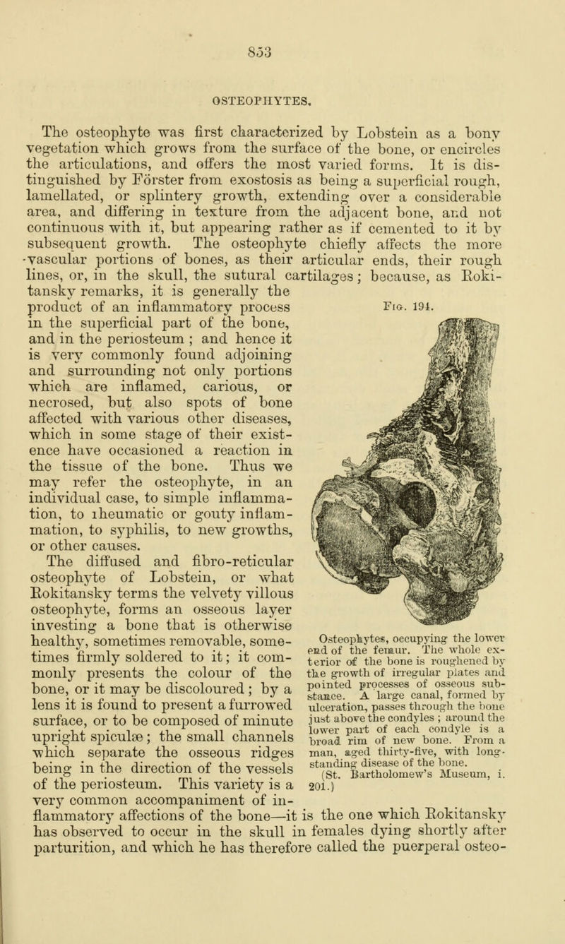 OSTEOPHYTES, The osteopliyte was first characterized by Lobsteln as a bony vegetation which grows from the surface of the bone, or encircles the articulations, and offers the most varied forms. It is dis- tinguished by Forster from exostosis as being a superficial rough, lamellated, or splintery growth, extending over a considerable area, and differing in texture from the adjacent bone, and not continuous with it, but appearing rather as if cemented to it by subsequent growth. The osteophyte chiefly affects the more -vascular portions of bones, as their articular ends, their rough lines, or, in the skull, the sutaral cartilages; because, as Eoki- tansky remarks, it is generally the product of an inflammatory process Fio- 191. in the superficial part of the bone, and in the periosteum ; and hence it is very commonly found adjoining and surrounding not only portions which are inflamed, carious, or necrosed, but also spots of bone affected with various other diseases, which in some stage of their exist- ence have occasioned a reaction in the tissue of the bone. Thus we may refer the osteophyte, in an individual case, to simple inflamma- tion, to iheumatic or gouty inflam- mation, to syphilis, to new growths, or other causes. The diffused and fibre-reticular osteophyte of Lobstein, or what Eokitansky terms the velvety villous osteophyte, forms an osseous layer investing a bone that is otherwise healthy, sometimes removable, some- times firmly soldered to it; it com- monly presents the colour of the bone, or it may be discoloured ; by a lens it is found to present a furrowed surface, or to be composed of minute upright spiculse; the small channels which separate the osseous ridges being in the direction of the vessels Osteopkytes, oecupying the lower evLd of the femur. The whole ex- terior of the bone is roug-liened by the g^^owth of irregular plates and pointed processes of osseous sub- stamce. A large canal, formed by ulceration, passes through the hone just above the condyles ; around the lower part of each condyle is a broad rim of new bone. From a man, aged thirty-five, with long- standing disease of the bone. (St. Bartholomew's Museum, i. 201.) of the periosteum. This variety is a very common accompaniment of in- flammatory affections of the bone—it is the one which Eokitansky has observed to occur in the skull in females dying shortly after parturition, and which he has therefore called the puerperal osteo-