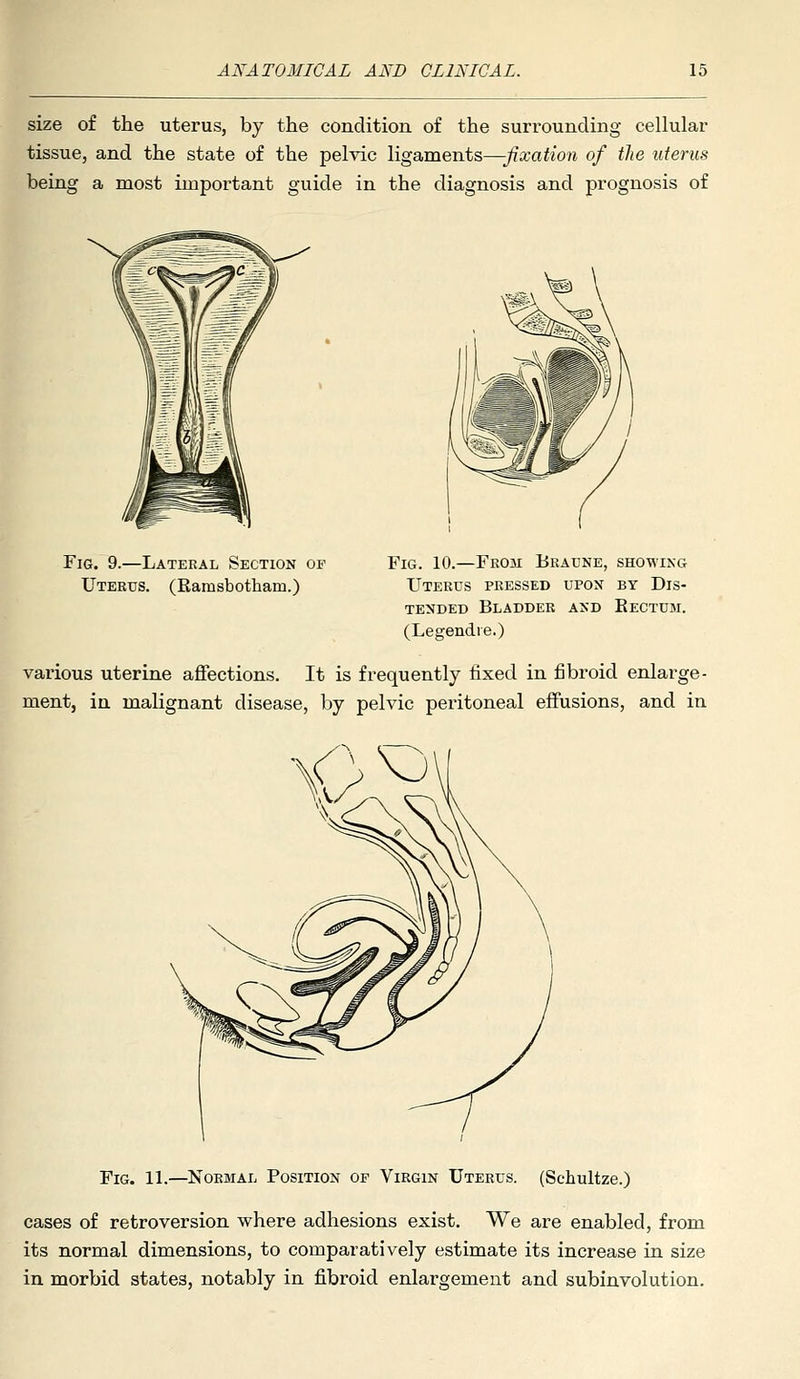 size of the uterus, by the condition of the surrounding cellular tissue, and the state of the pelvic ligaments—fixation of the uterus being a most important guide in the diagnosis and prognosis of Fig. 9.—Lateral Section of Uterus. (Eamsbotham.) Fig. 10.—From Braune, showing Uterus pressed upon by Dis- tended Bladder and Rectum. (Legendie.) various uterine affections. It is frequently fixed in fibroid enlarge- ment, in malignant disease, by pelvic peritoneal effusions, and in Fig. 11.—Normal Position of Virgin Uterus. (Schultze.) cases of retroversion where adhesions exist. We are enabled, from its normal dimensions, to comparatively estimate its increase in size in morbid states, notably in fibroid enlargement and subinvolution.