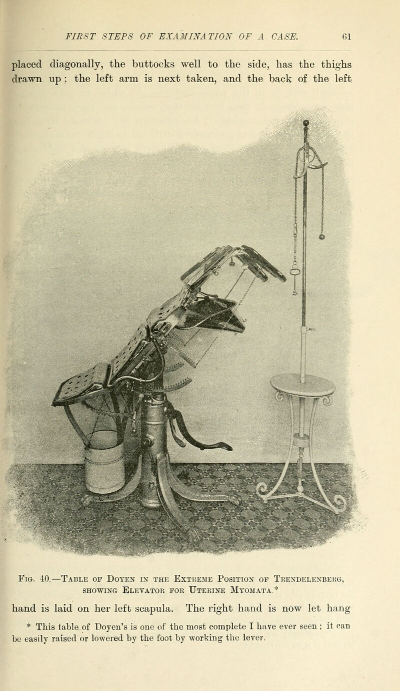 placed diagonally, the buttocks well to the side, has the thighs drawn up ; the left arm is next taken, and the back of the left ■V VJBjl''''*l^Wi^j!?  Fig. 40. -Table of Doyen in the Exteeme Position of Teendelenbekg, SHOWING Elevator for Uterine Myomata* hand is laid on her left scapula. The right hand is now let hang * This table of Doyen's is one of the most complete I have ever seen ; it can he easily raised or lowered by the foot by working the lever.