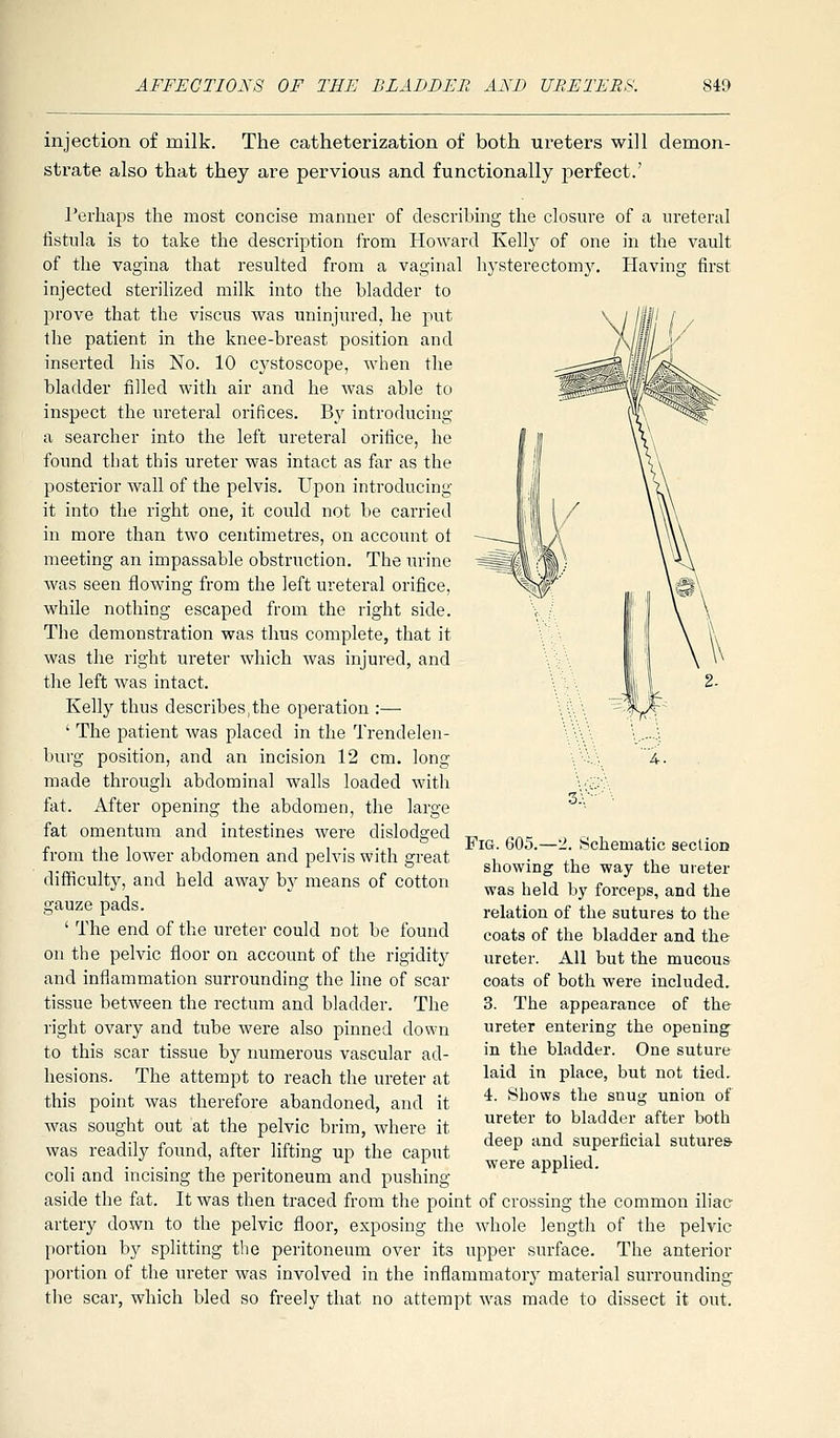 injection of milk. The catheterization of both ureters will demon- strate also that they are pervious and functionally perfect.' Terhaps the most concise manner of describing the closure of a ureteral fistula is to take the description from Howard Kelly of one in the vault of the vagina that resulted from a vaginal hysterectomy. Having first injected sterilized milk into the bladder to prove that the viscus was uninjured, he put the patient in the knee-breast position and inserted his No. 10 cystoscope, when the bladder filled with air and he was able to inspect the ureteral orifices. By introducing a searcher into the left ureteral orifice, he found that this ureter was intact as far as the posterior wall of the pelvis. Upon introducing it into the right one, it could not be carried in more than two centimetres, on account ot meeting an impassable obstruction. The iirine was seen flowing from the left ureteral orifice, while nothing escaped from the right side. The demonstration was thus complete, that it was the right ureter which was injured, and the left was intact. Kelly thus describes,the operation :— ' The patient was placed in the Trendelen- burg position, and an incision 12 cm. long made through abdominal walls loaded with fat. After opening the abdomen, the large fat omentum and intestines were dislodged from the lower abdomen and pelvis with great difficulty, and held away by means of cotton gauze pads. ' The end of the ureter could not be found on the pelvic floor on account of the rigidity and inflammation surrounding the line of scar tissue between the rectum and bladder. The right ovary and tube were also pinned down to this scar tissue by rmmerous vascular ad- hesions. The attempt to reach the ureter at this point was therefore abandoned, and it was sought out at the pelvic brim, where it was readily found, after lifting up the caput coli and incising the peritoneum and pushing aside the fat. It was then traced from the point of crossing the common iliac artery down to the pelvic floor, exposing the whole length of the pelvic portion by splitting the peritoneum over its upper surface. The anterior portion of the ureter was involved in the inflammatory material surrounding the scar, which bled so freely that no attempt was made to dissect it out. 3;- ■ ^ Fig. 605.—'1. Schematic section showing the way the ureter was held by forceps, and the relation of the sutures to the coats of the bladder and the ureter. All but the mucous coats of both were included. 3. The appearance of the ureter entering the opening in the bladder. One suture laid in place, but not tied. 4. Shows the snug union of ureter to bladder after both deep and superficial sutures were applied.