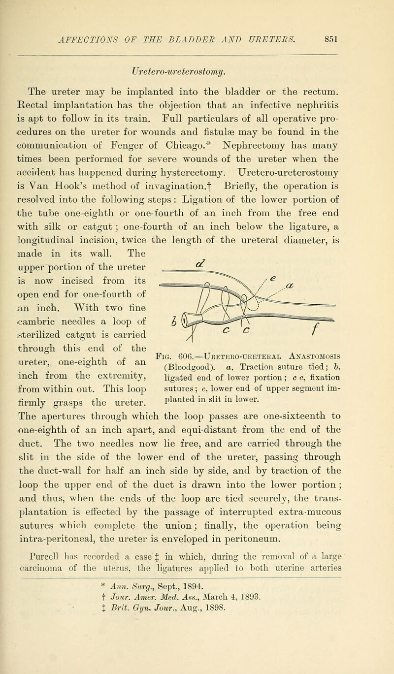 Uretero-ureterostomy. The ureter may be implanted into the bladder or the rectum. Rectal implantation has the objection that an infective nephritis is apt to follow in its train. Full particulars of all operative pro- cedures on the ureter for wounds and fistulas may be found in the communication of Fenger of Chicago.* Nephrectomy has many times been performed for severe wounds of the ureter when the accident has happened during hysterectomy. Uretero-ureterostomy is Van Hook's method of invagination.! Briefly, the operation is resolved into the following steps : Ligation of the lower portion of the tube one-eighth or oae-fourth of an inch from the free end with silk or catgut; one-fourth of an inch below the ligature, a longitudinal incision, twice the length of the ureteral diameter, is made in its wall. The upper portion of the ureter ^ is now incised from its open end for one-fourth of an inch. With two fine cambric needles a loop of sterilized catgut is carried through this end of the ureter, one-eighth of an inch from the extremity, from within out. This loop firmly grasps the ureter. The apertures through which the loop passes are one-sixteenth to ■one-eighth of an inch apart, and equi-distant from the end of the duct. The two needles now lie free, and are carried through the slit in the side of the lower end of the ureter, passing through the duct-wall for half an inch side by side, and by traction of the loop the upper end of the duct is drawn into the lower portion; and thus, when the ends of the loop are tied securely, the trans- plantation is effected by the passage of interrupted extra-mucous sutures which complete the union; finally, the operation being intra-peritoneal, the ureter is enveloped in peritoneum. Purcell has recorded a case J in which, during the removal of a large carcinoma of the uterus, the ligatures applied to both uterine arteries Fig. 606.—Ueetero-ueetekal Anastomosis (Bloodgood). a. Traction suture tied; 6, ligated end of lower portion; c c, fixation sutures; e, lower end of upper segment im- planted in slit in lower. * Ann. Surg., Sept., 1894. t Jour. Amer. Med. Ass., 3Iarcli 4, 1893. X Brit. Gyn. Jour., Aug., 1898.