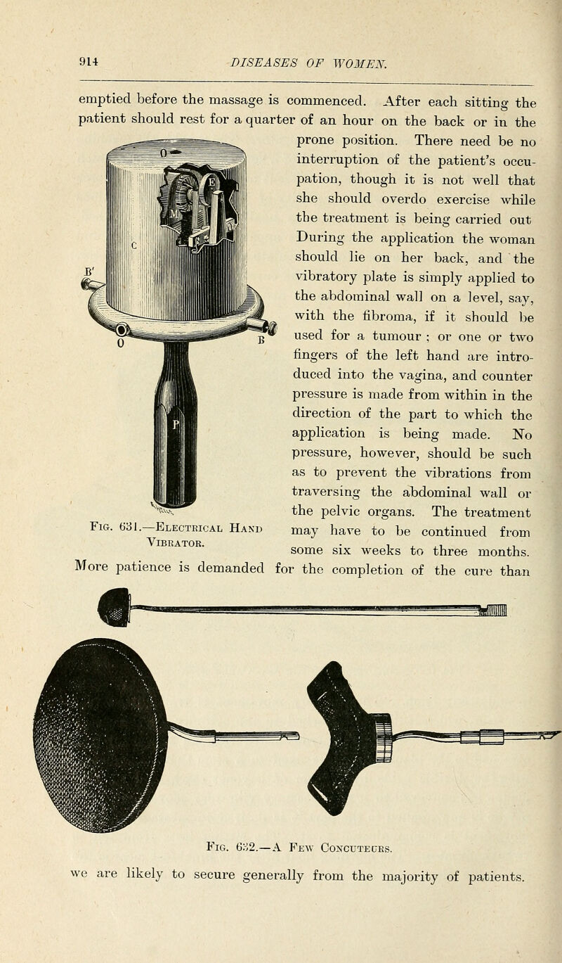emptied before the massage is commenced. After each sitting the patient should rest for a quarter of an hour on the back or in the prone position. There need be no interruption of the patient's occu- pation, though it is not well that she should overdo exercise while the treatment is being carried out During the application the woman should lie on her back, and the vibratory plate is simply applied to the abdominal wall on a level, say, with the fibroma, if it should be used for a tumour ; or one or two fingers of the left hand are intro- duced into the vagina, and counter pressure is made from within in the direction of the part to which the application is being made. No pressure, however, should be such as to prevent the vibrations from traversing the abdominal wall or the pelvic organs. The treatment may have to be continued from some six weeks to three months. Fig. 631.—Electeical Hand Vibrator. More patience is demanded for the completion of the cure than Fig. 6o2.—a Few Goncuteces. we are likely to secure generally from the majority of patients.