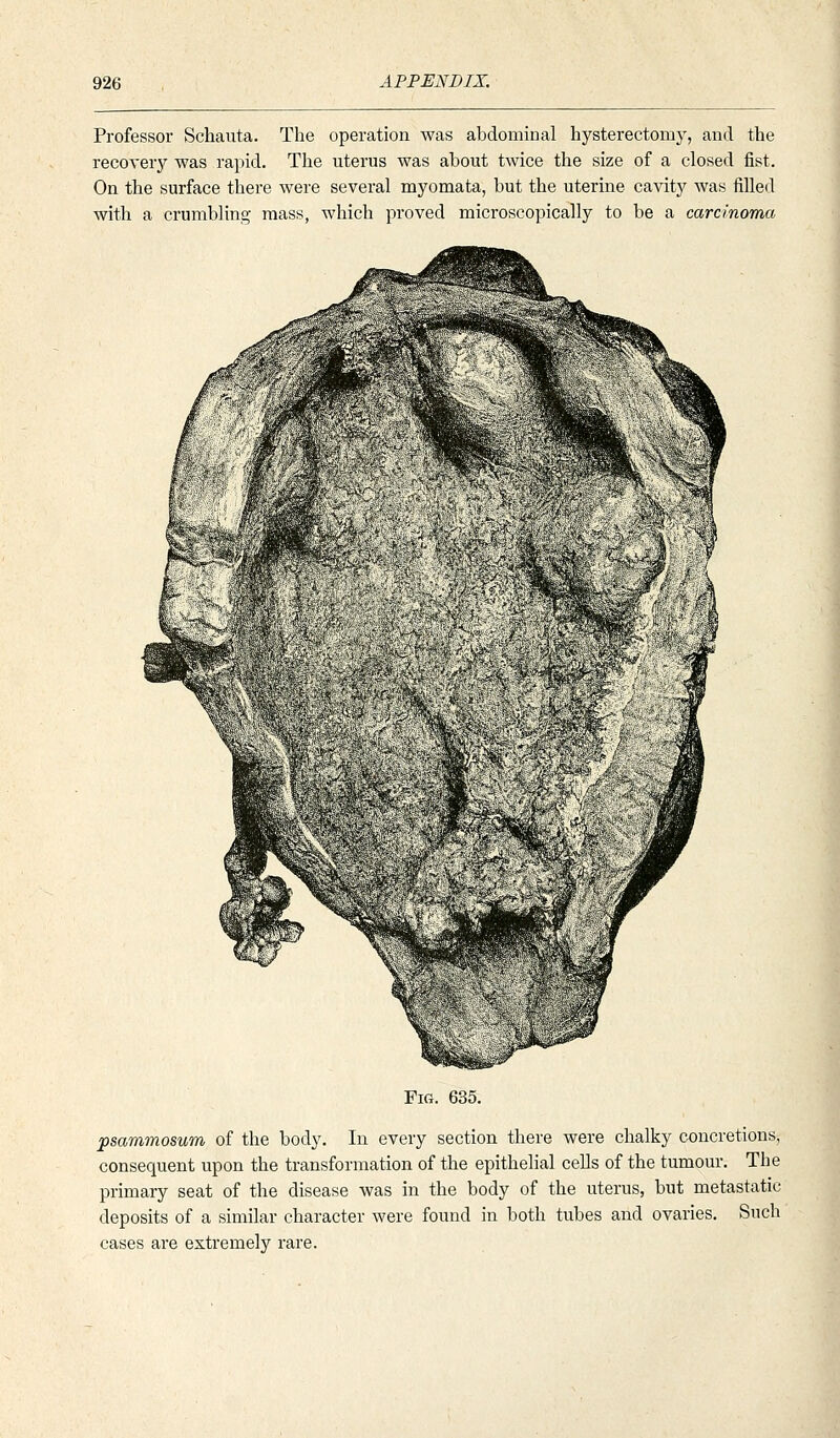 Professor Schauta. The operation was abdominal hysterectomy, and the recoverjf was rapid. The uterus was about twice the size of a closed fist. On the surface there were several myomata, but the uterine cavity was filled with a crumbling mass, which proved microscopically to be a carcinoma Fig. 635. psammosum of the body. In every section there were chalky concretions, consequent upon the transformation of the epithelial cells of the tumour. The primary seat of the disease was in the body of the uterus, but metastatic deposits of a similar character were found in both tubes and ovaries. Such cases are extremely rare.