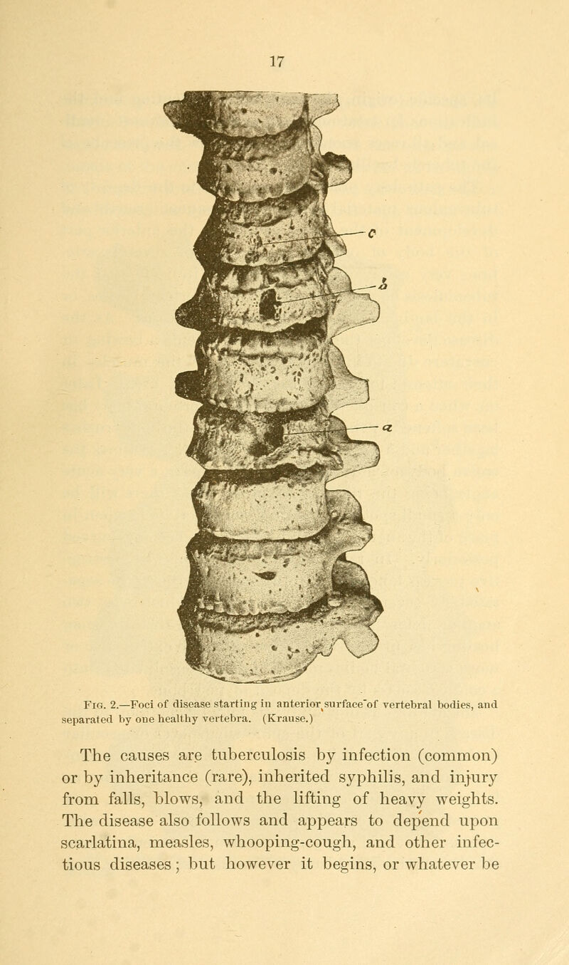 Fig. 2.—Foci of disease starting in anterior%snrface~of vertebral bodies, and separated by one healtby vertebra. (Kranse.) The causes are tuberculosis by infection (common) or by inheritance (rare), inherited syphilis, and injury from falls, Mows, and the lifting of heavy weights. The disease also follows and appears to depend upon scarlatina, measles, whooping-cough, and other infec- tious diseases; but however it begins, or whatever be