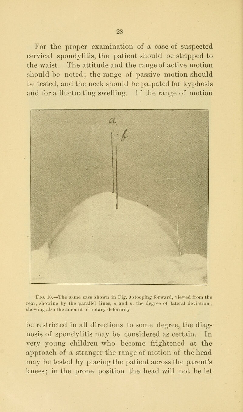 For the proper examination of a case of suspected cervical spondylitis, the patient should be stripped to the waist. The attitude and the range of active motion should be noted; the range of passive motion should be tested, and the neck should be palpated for kyphosis and for a fluctuating swelling. If the range of motion Fig. 10.—The same case shown in Fig. 9 stooping forward, viewed from the rear, showing by the parallel lines, a and b, the degree of lateral deviation ; showing also the amount of rotary deformity. be restricted in all directions to some degree, the diag- nosis of spondylitis may be considered as certain. In very young children who become frightened at the approach of a stranger the range of motion of the head may be tested by placing the patient across the parent's knees; in the prone position the head will not be let