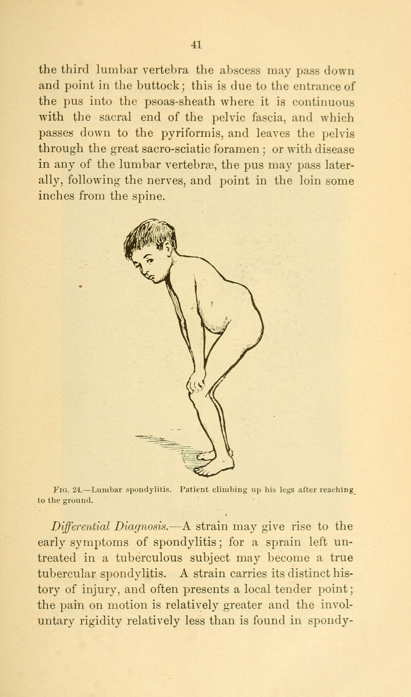 the third lumbar vertebra the abscess may pass down and point in the buttock; this is due to the entrance of the pus into the psoas-sheath where it is continuous with the sacral end of the pelvic fascia, and which passes down to the pyriformis, and leaves the pelvis through the great sacro-sciatic foramen; or with disease in any of the lumbar vertebrae, the pus may pass later- ally, following the nerves, and point in the loin some inches from the spine. Fig. 24.—Lumbar spondylitis. Patient climbing up his legs after reaching to the ground. Differential Diagnosis.—A strain may give rise to the early symptoms of spondylitis; for a sprain left un- treated in a tuberculous subject may become a true tubercular spondylitis. A strain carries its distinct his- tory of injury, and often presents a local tender point; the pain on motion is relatively greater and the invol- untary rigidity relatively less than is found in spondy-