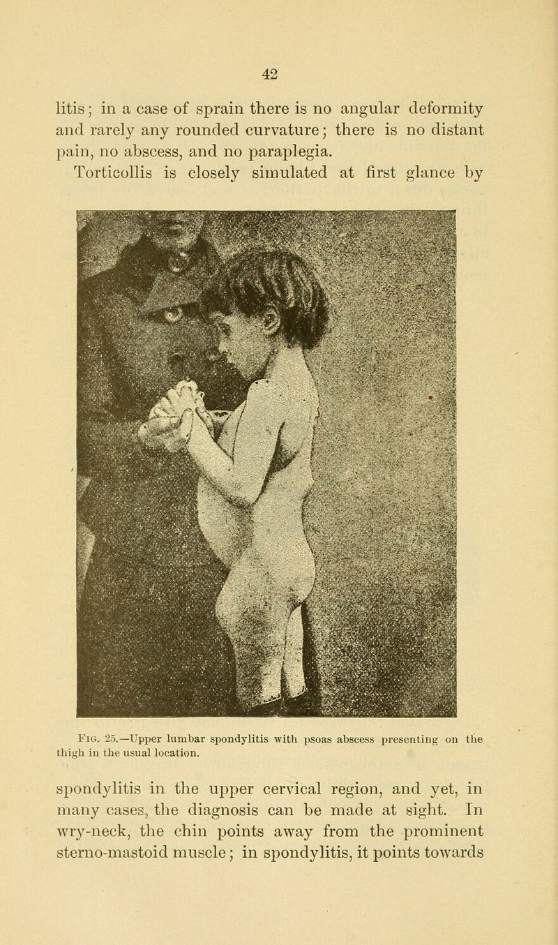 litis; in a case of sprain there is no angular deformity and rarely any rounded curvature; there is no distant pain, no abscess, and no paraplegia. Torticollis is closely simulated at first glance by Fig. 25.—Upper lumbar spondylitis with psoas abscess presenting on the thigh in the usual location. spondylitis in the upper cervical region, and yet, in many cases, the diagnosis can be made at sight. In wry-neck, the chin points away from the prominent sterno-mastoid muscle; in spondylitis, it points towards